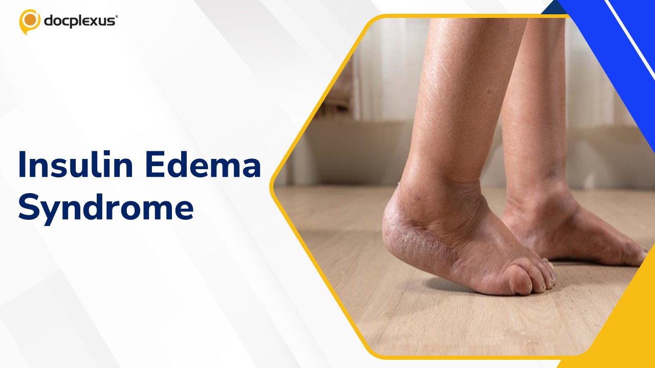Insulin Edema Syndrome: A Rare Manifestation of Insulin Therapy