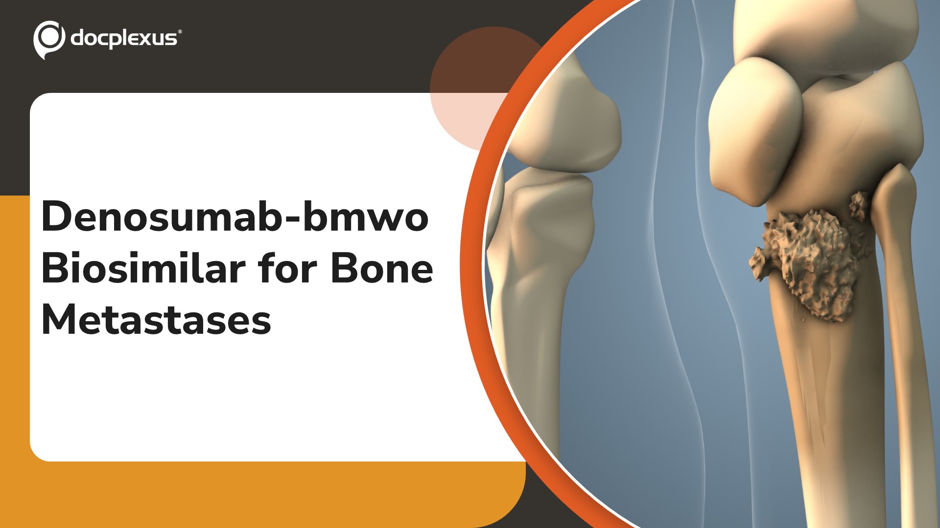 USFDA Approves Denosumab-bmwo Biosimilar for Bone Metastases