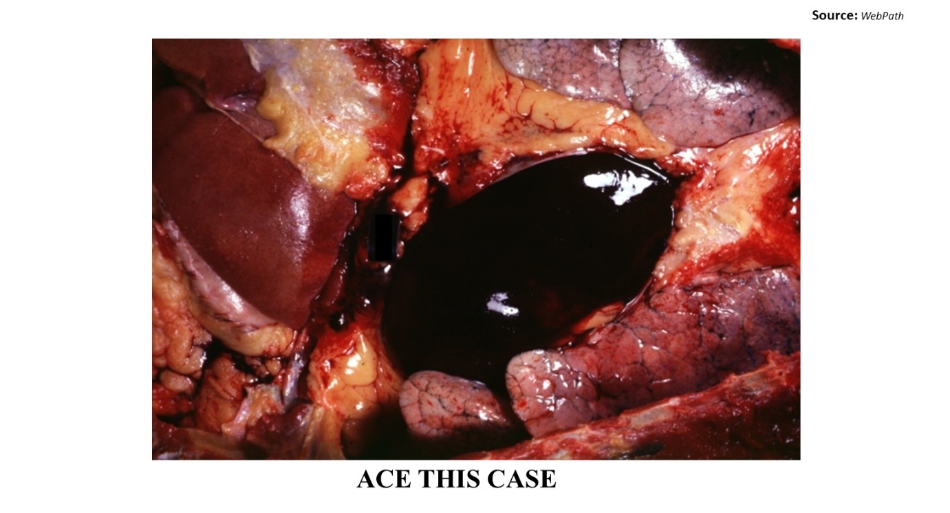 A Case of Myocardial Infarction in an Old Woman