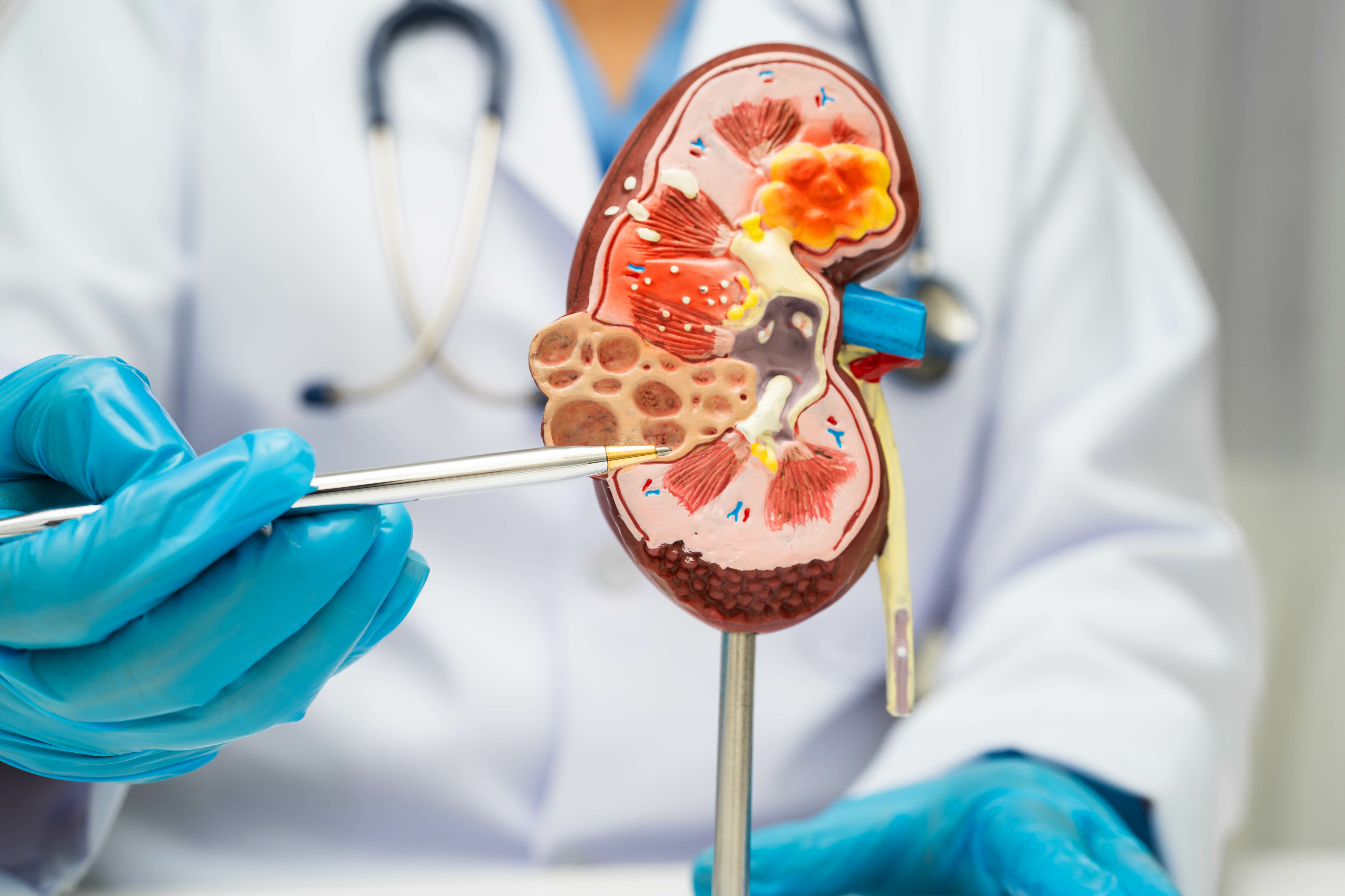 Use Of Oral Anticoagulation In The Management Of Atrial Fibrillation In Patients With ESRD: Con