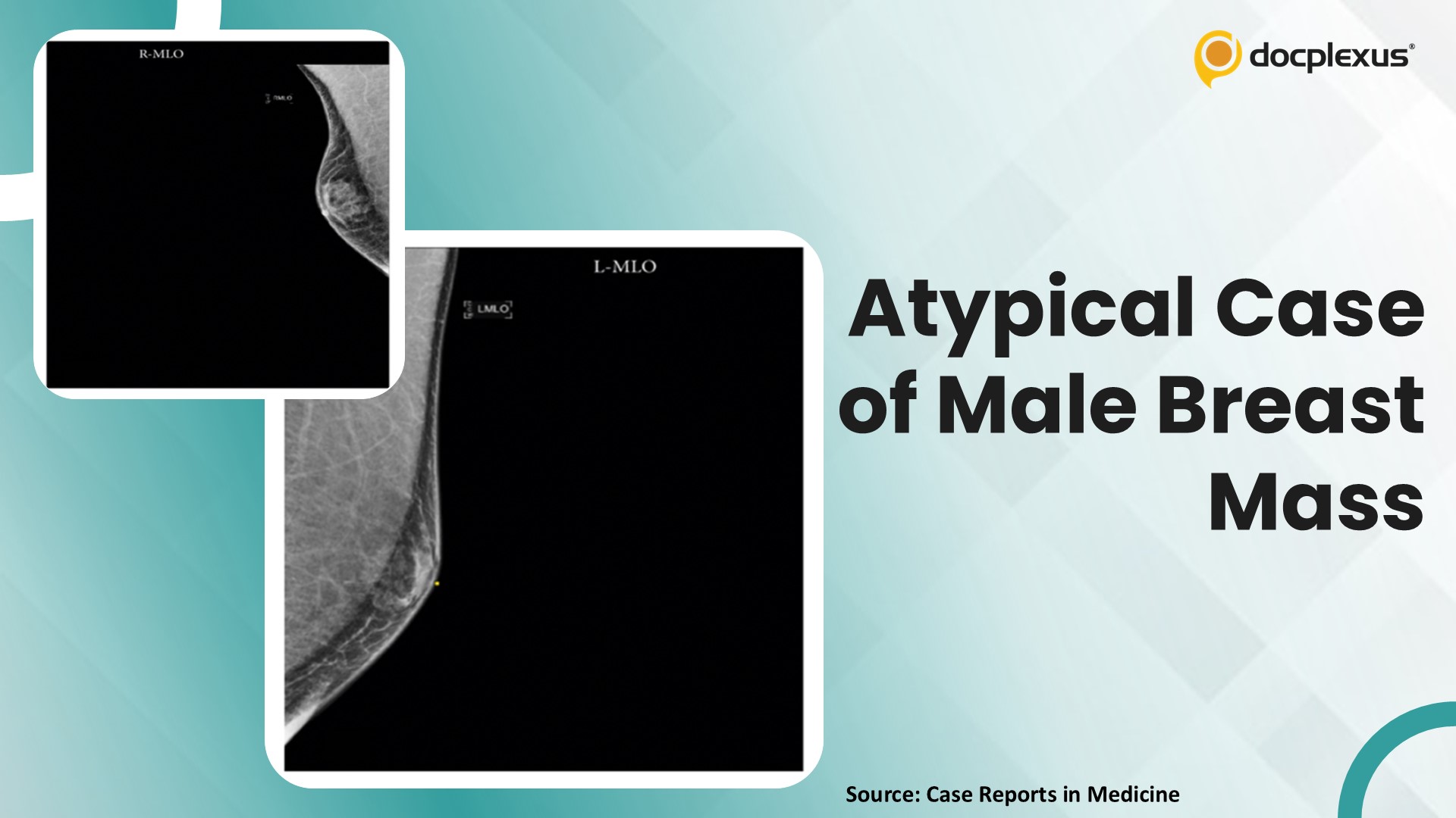An Unusual Presentation of Breast Mass in a Male Patient