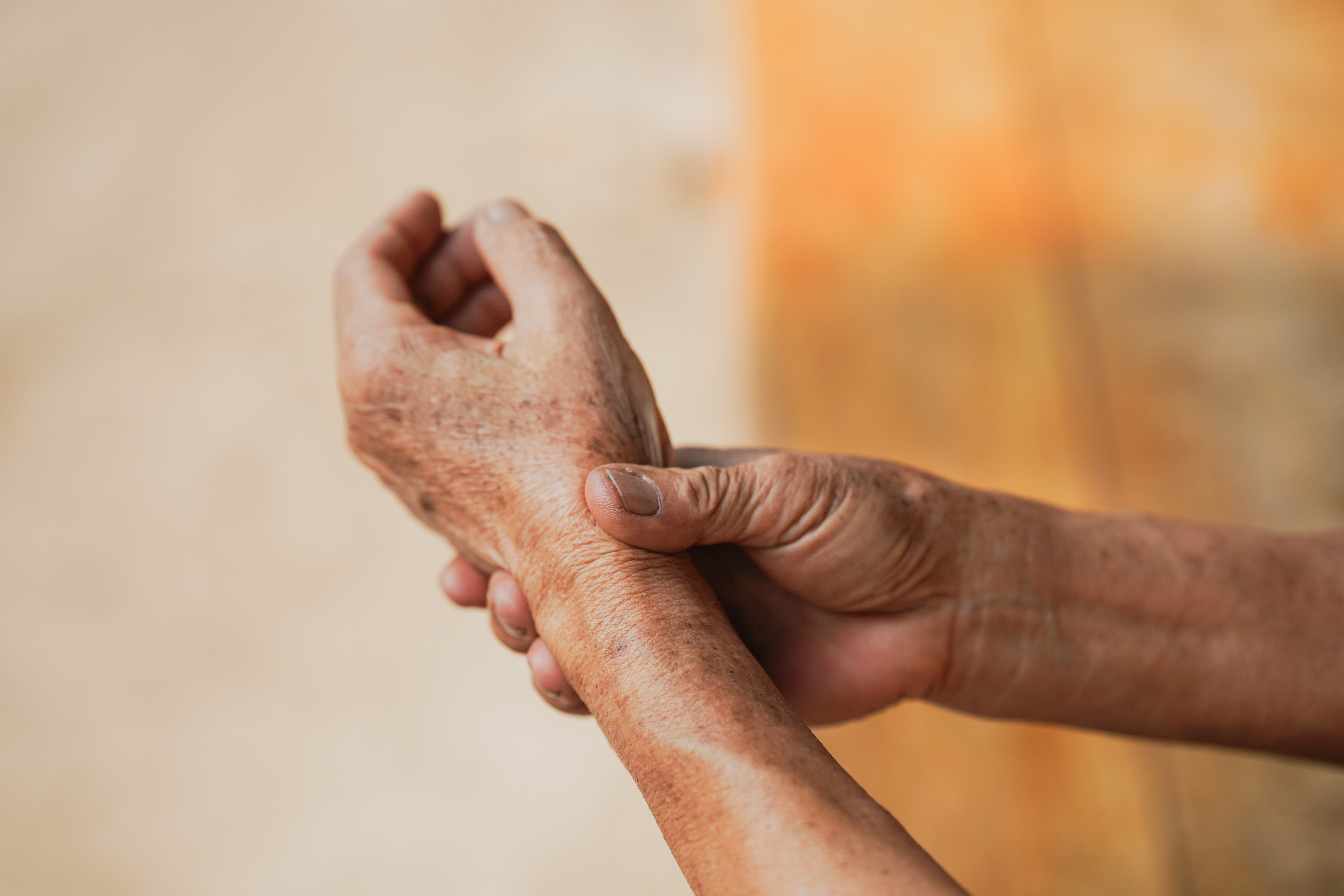 Prevalence And Clinical Patterns Of Psoriatic Arthritis In Indian Patients With Psoriasis