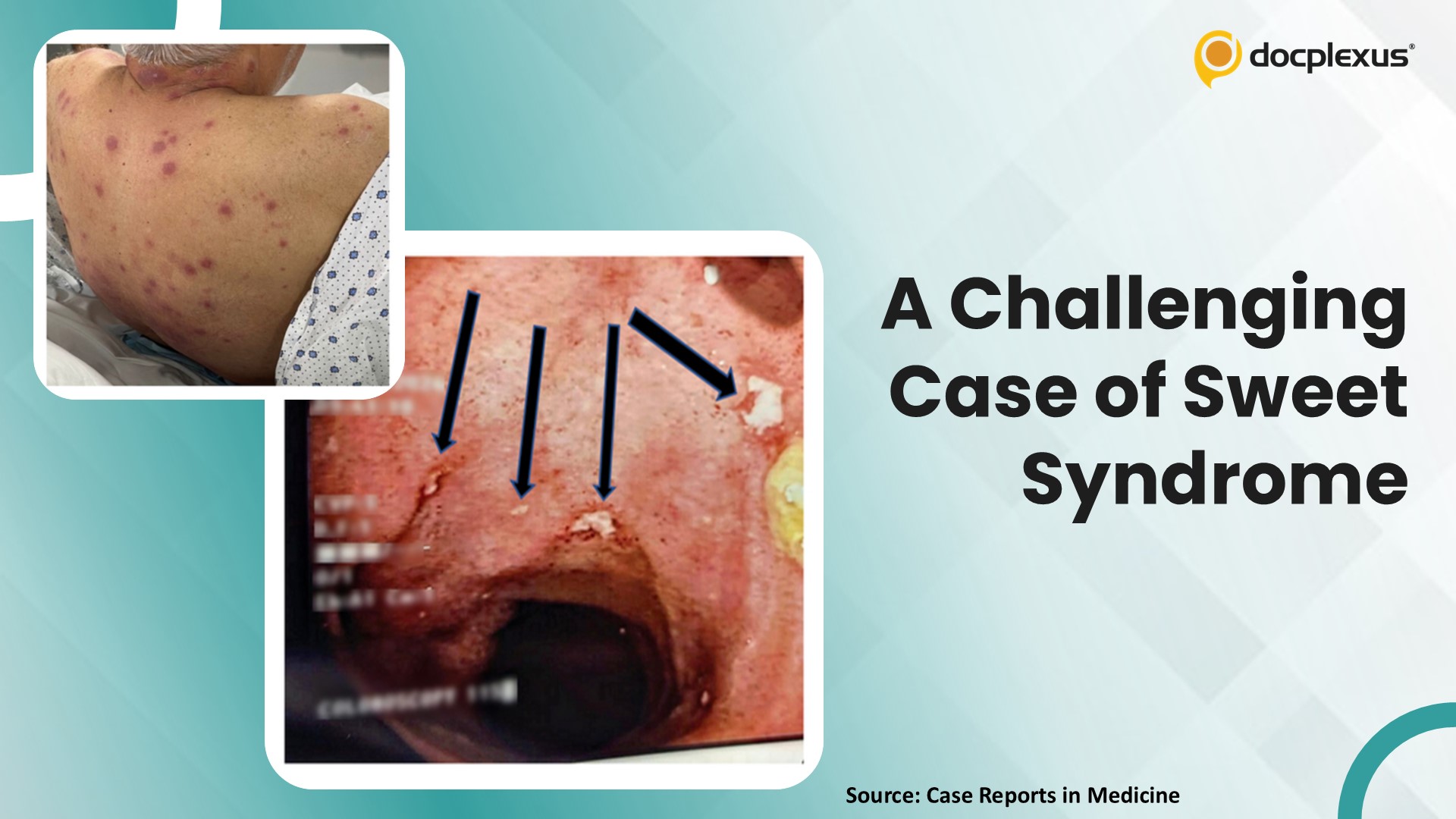 Sweet Syndrome: A Rare Cutaneous Manifestation of Inflammatory Bowel Disease