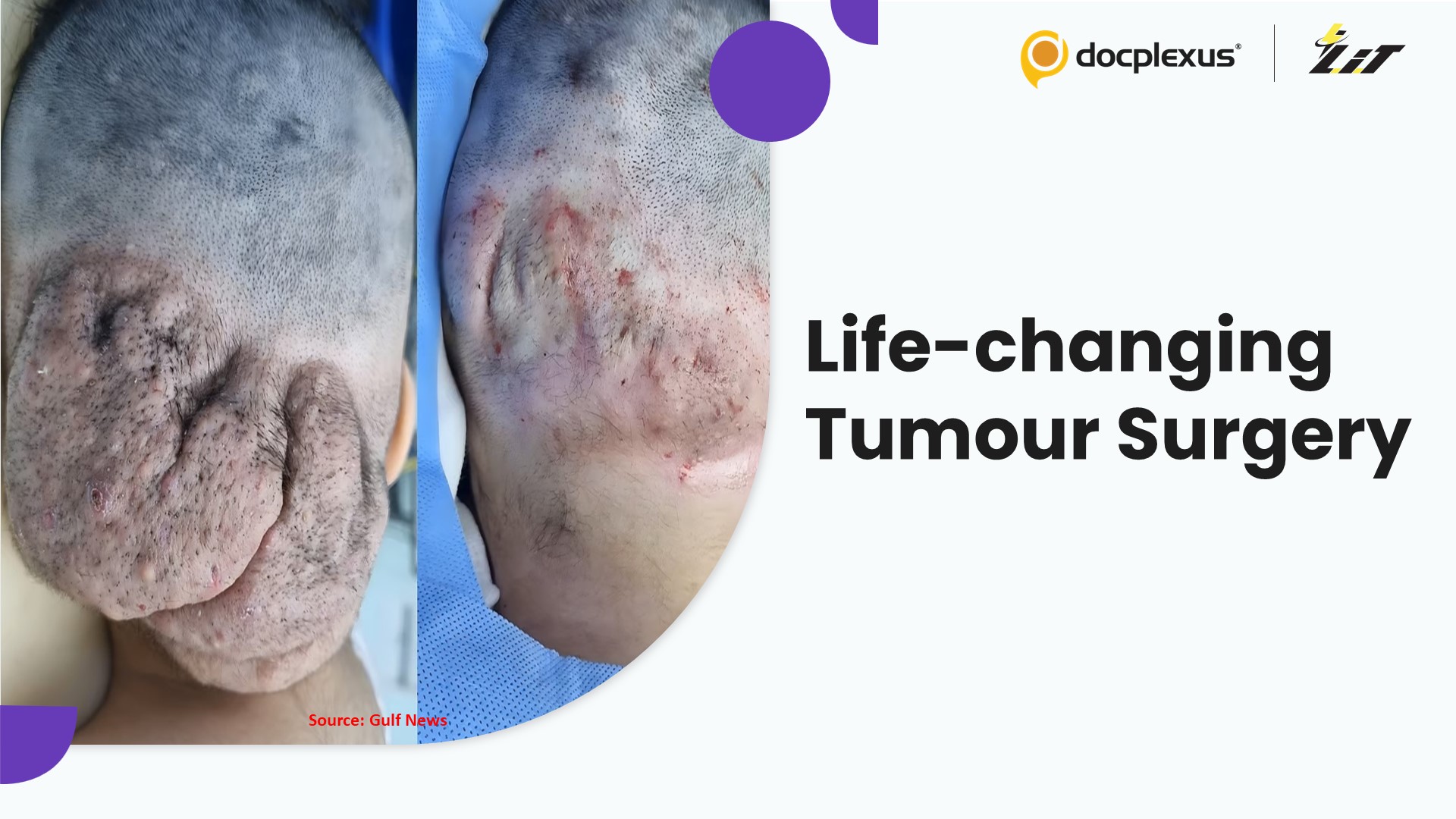 Surgeons Remove Massive Scalp Tumour in Rare Pediatric Case