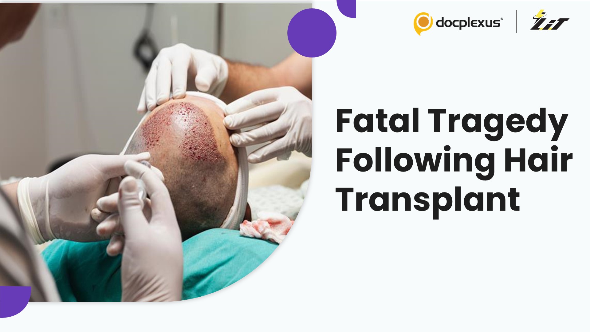 Another Life Lost After Hair Transplant by Same Kanpur Doctor