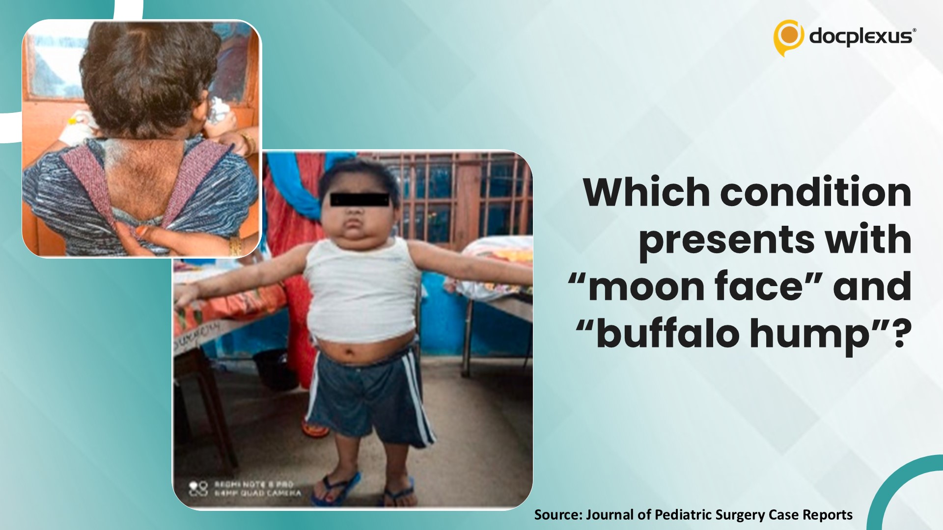 Can You Identify the Condition with “Moon Face” and “Buffalo Hump”?