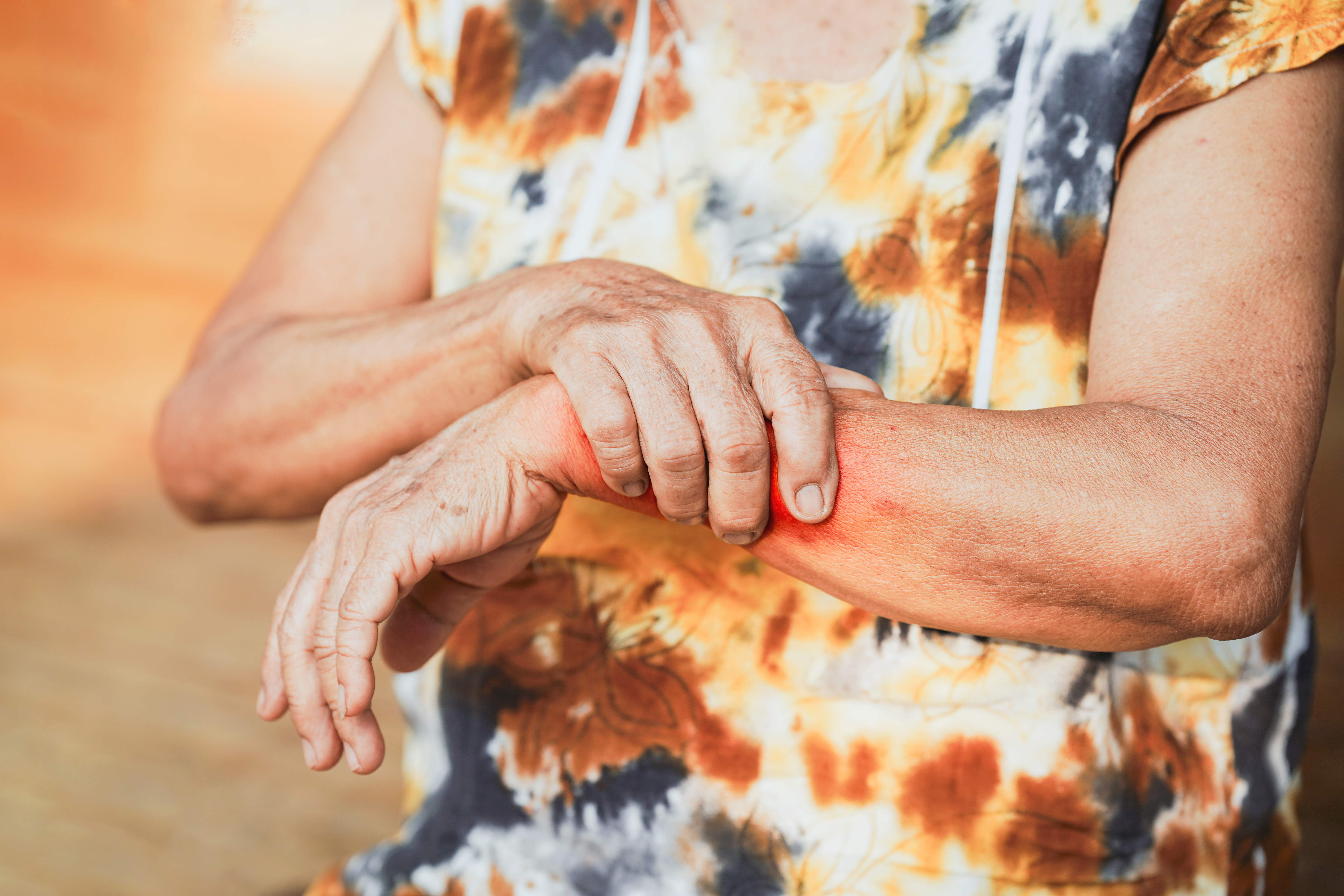 Treatment And Comorbidities In Psoriatic Arthritis: A Multicentre Study From Western India