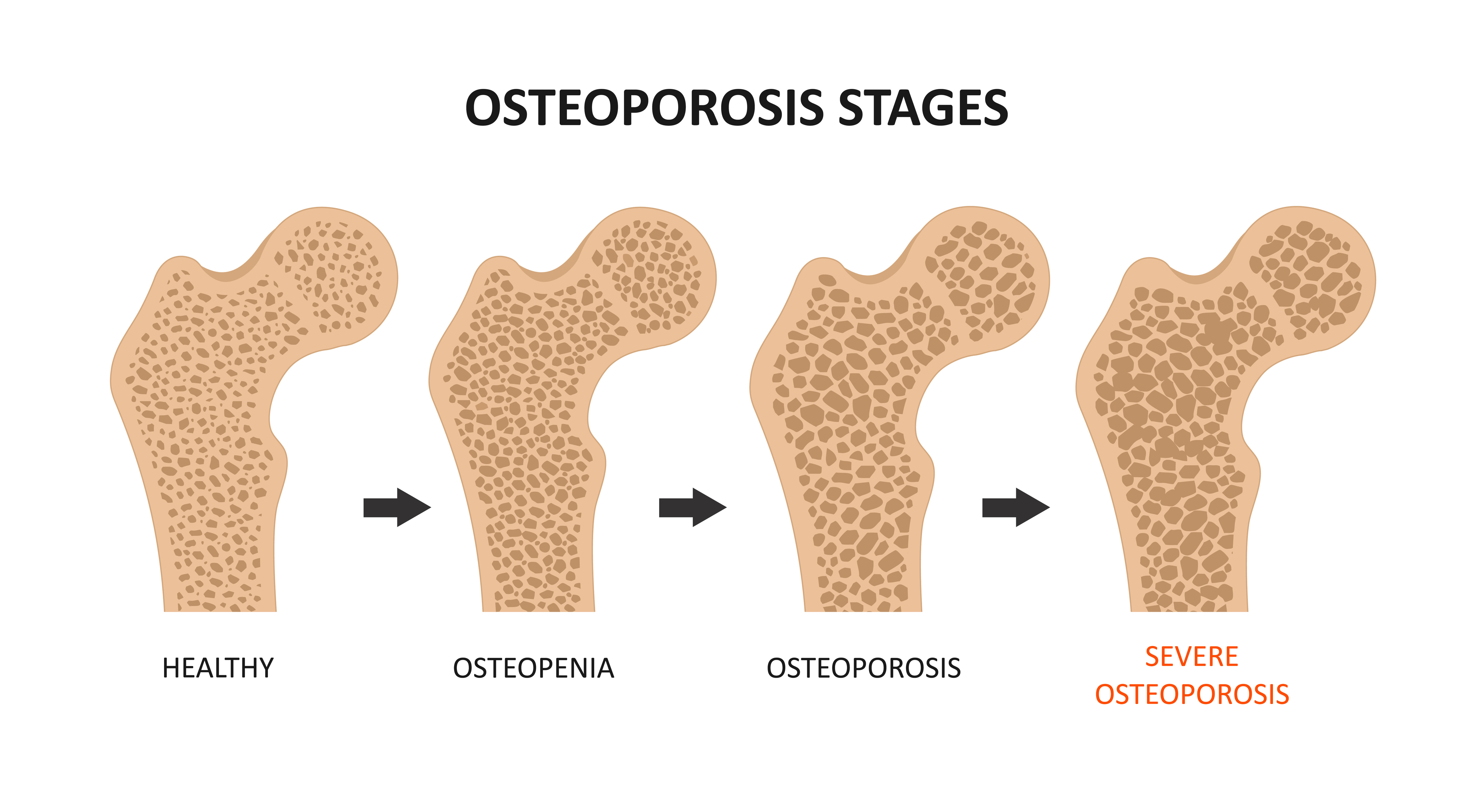 Assessment Of Knowledge Of Osteoporosis Among Female Nursing Students And Staff Nurses In An Urban Medical College In India