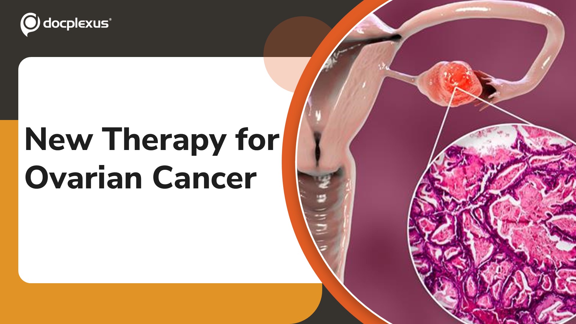 USFDA Approves Combination Therapy for Low-Grade Serous Ovarian Cancer
