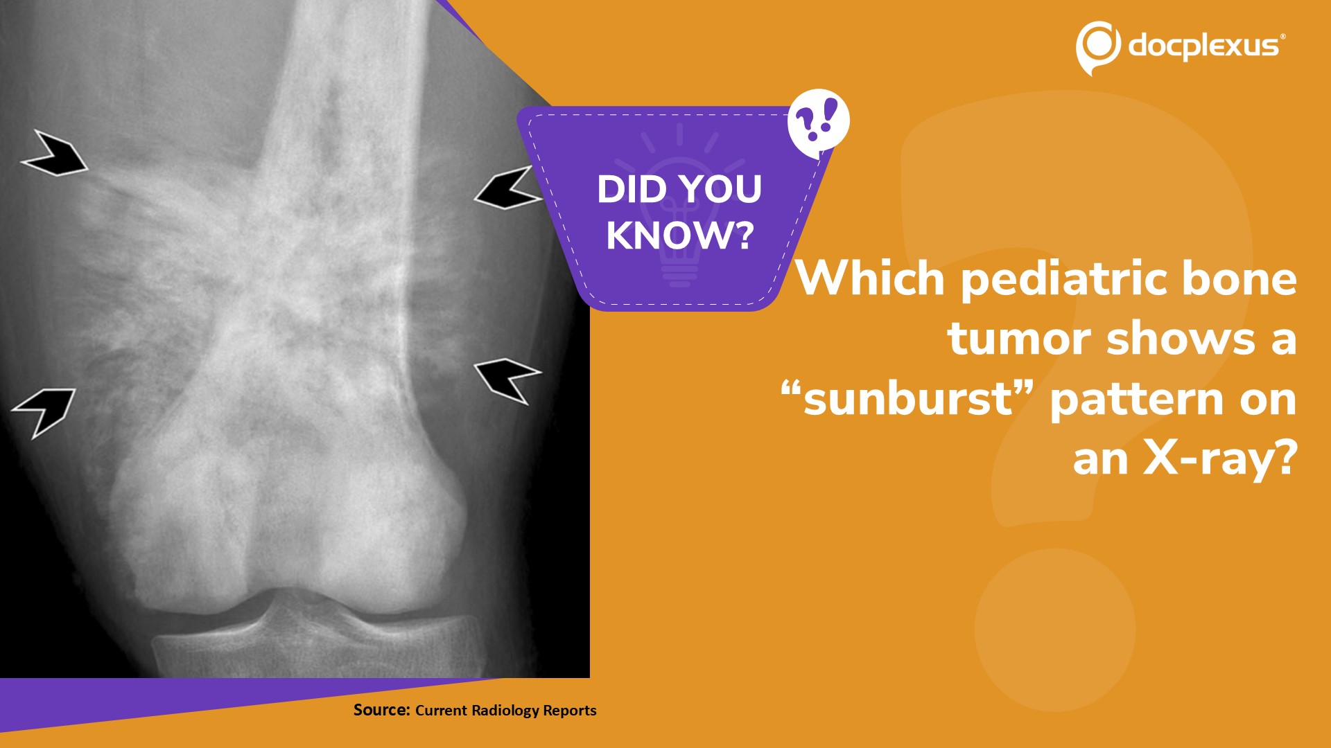 Identify the Pediatric Bone Tumor That Typically Shows a “Sunburst” Pattern on an X-Ray