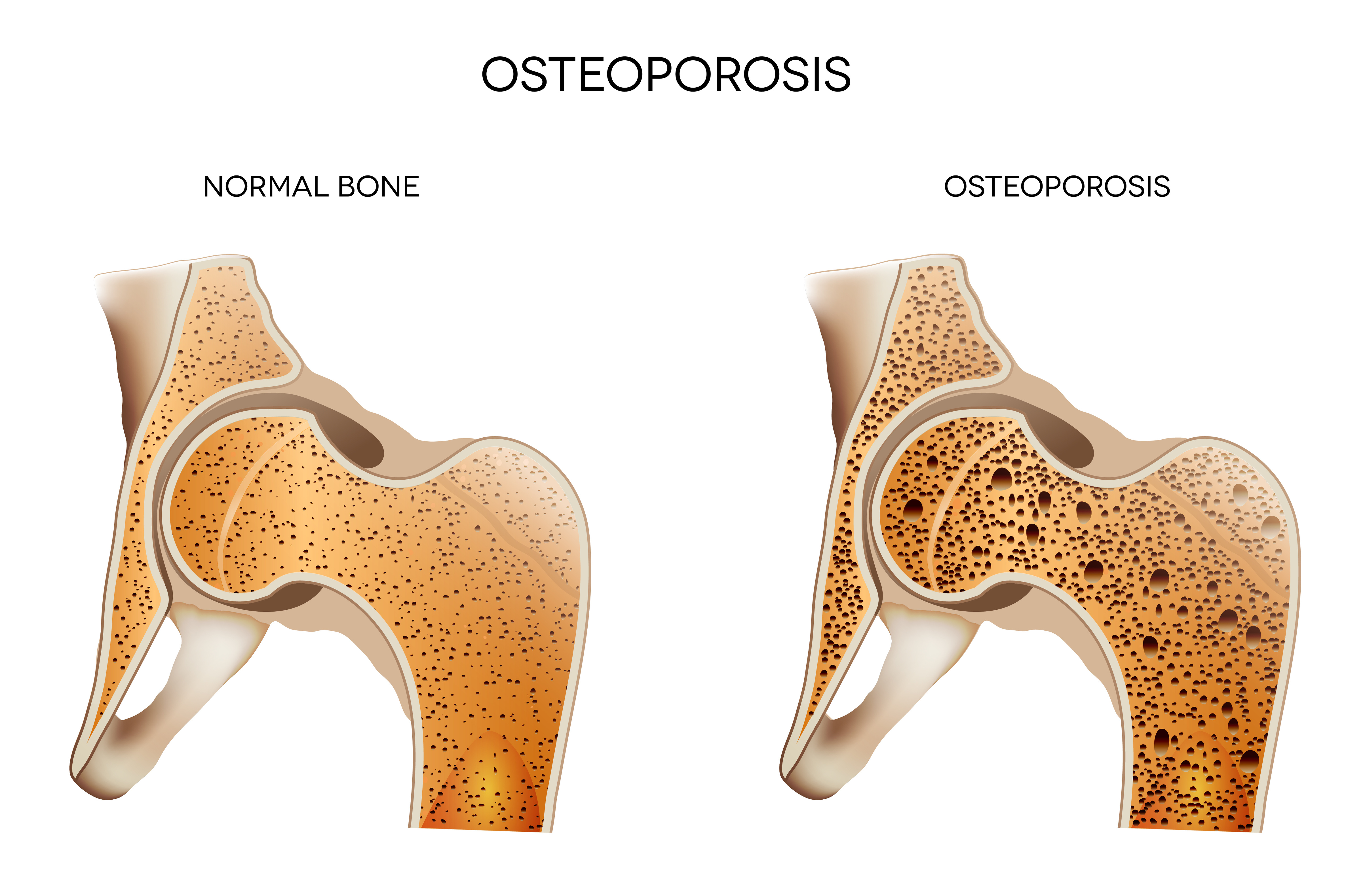 A Prospective, Observational Study Of Osteoporosis In Men