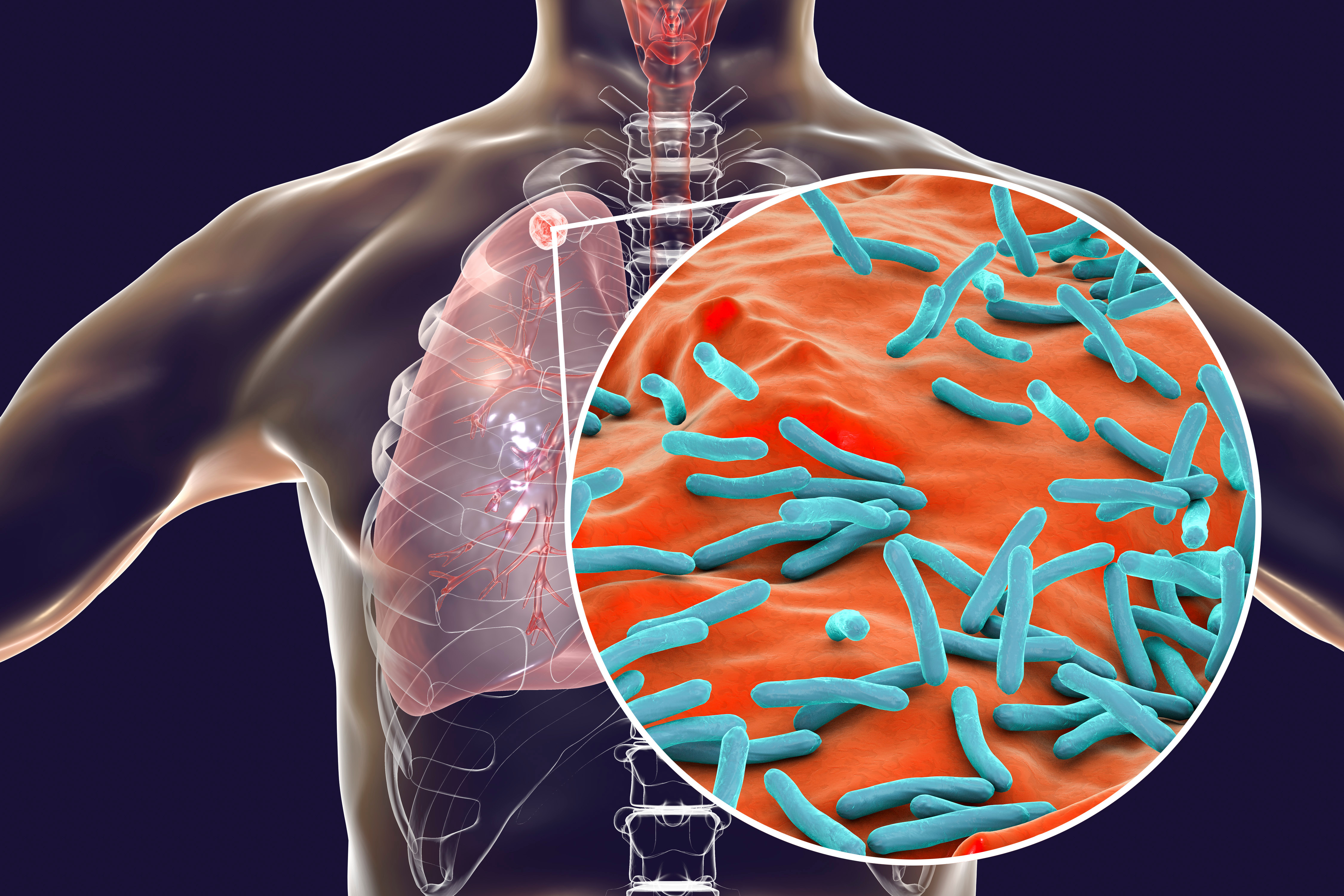 Clinical Presentation of Tuberculosis in HIV Positive Patients in Relation to CD4 Counts