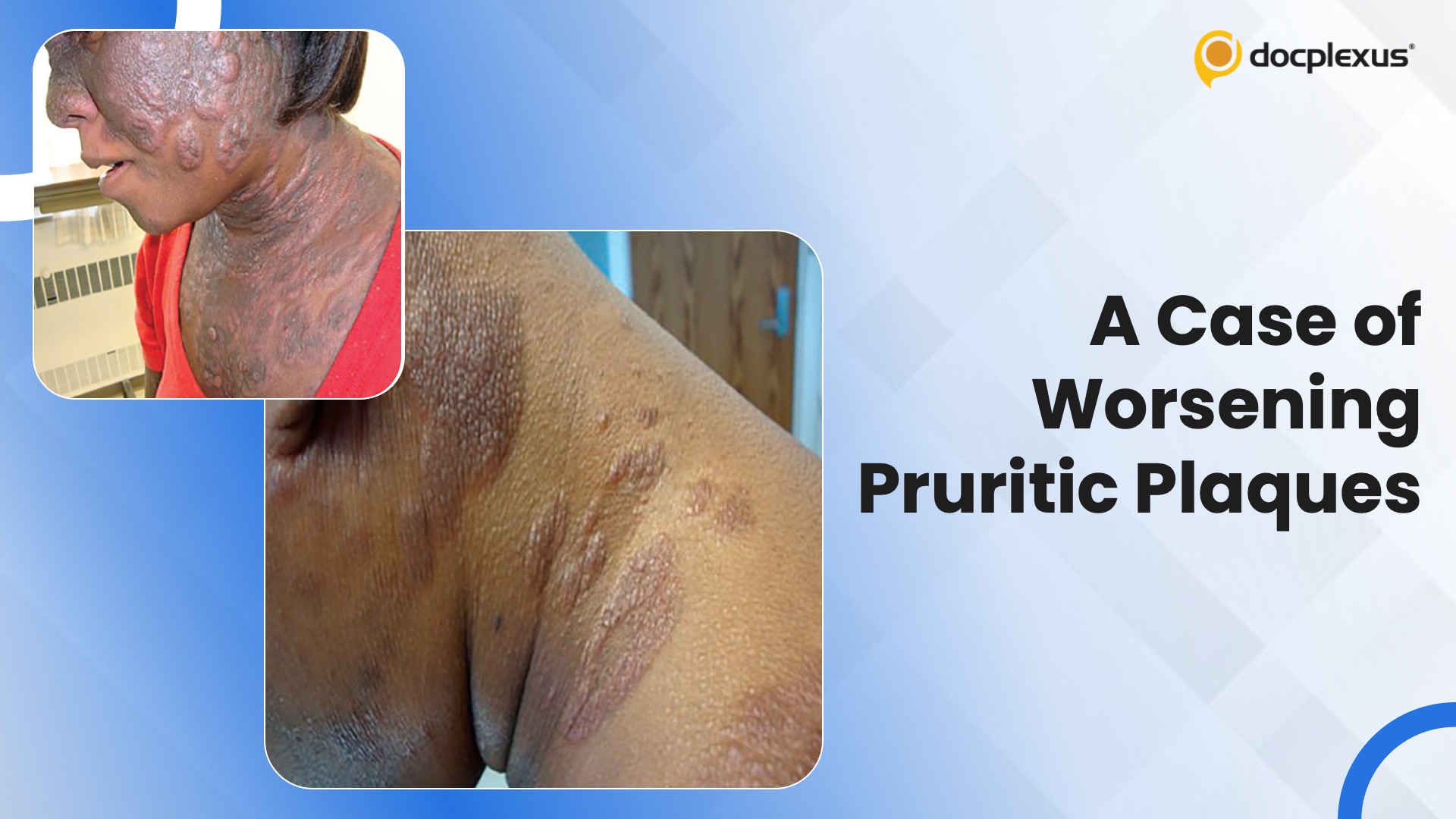 A Case of Worsening Pruritic Plaques