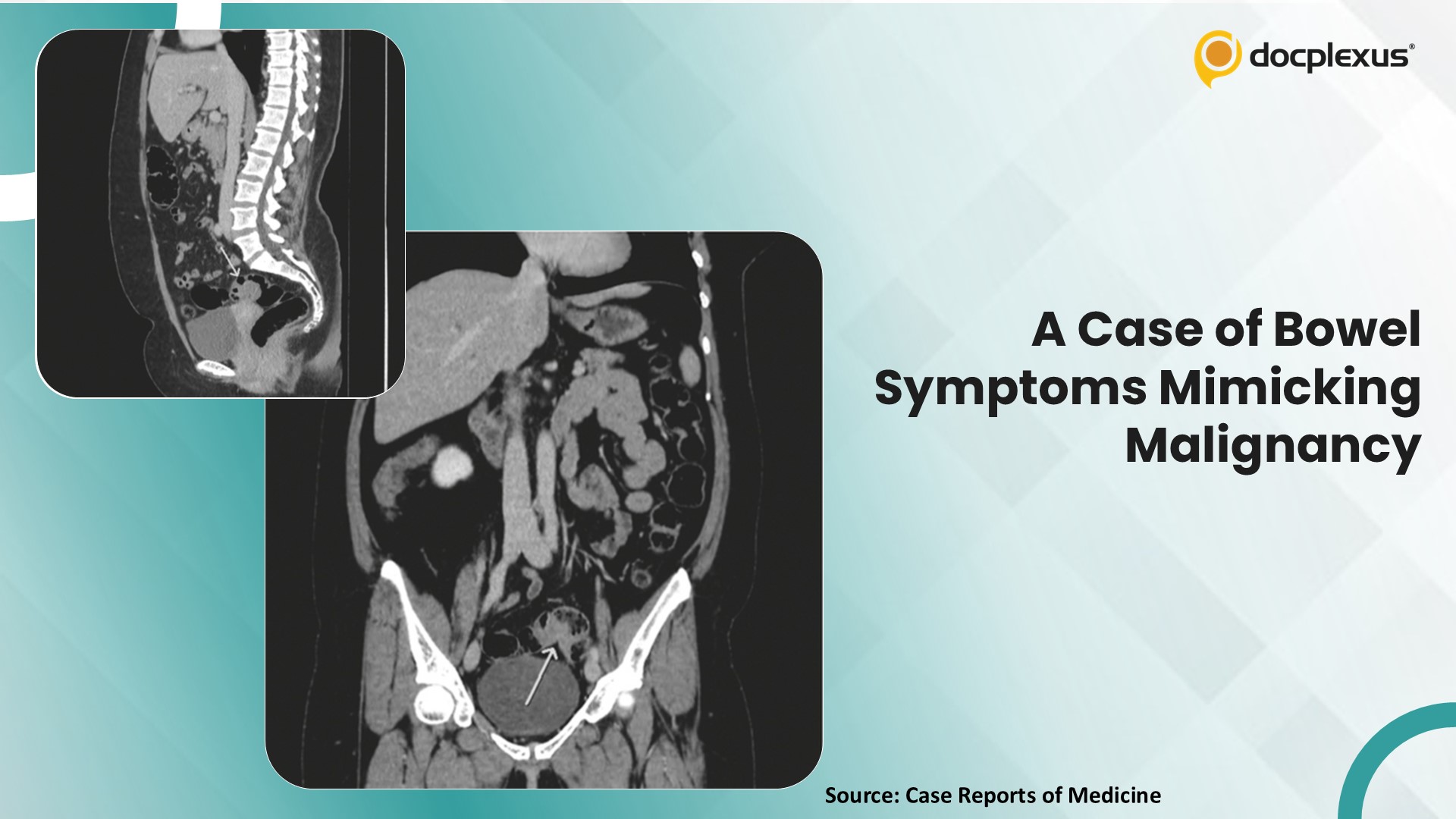 Can You Identify the Cause of These Bowel Symptoms Mimicking Malignancy?