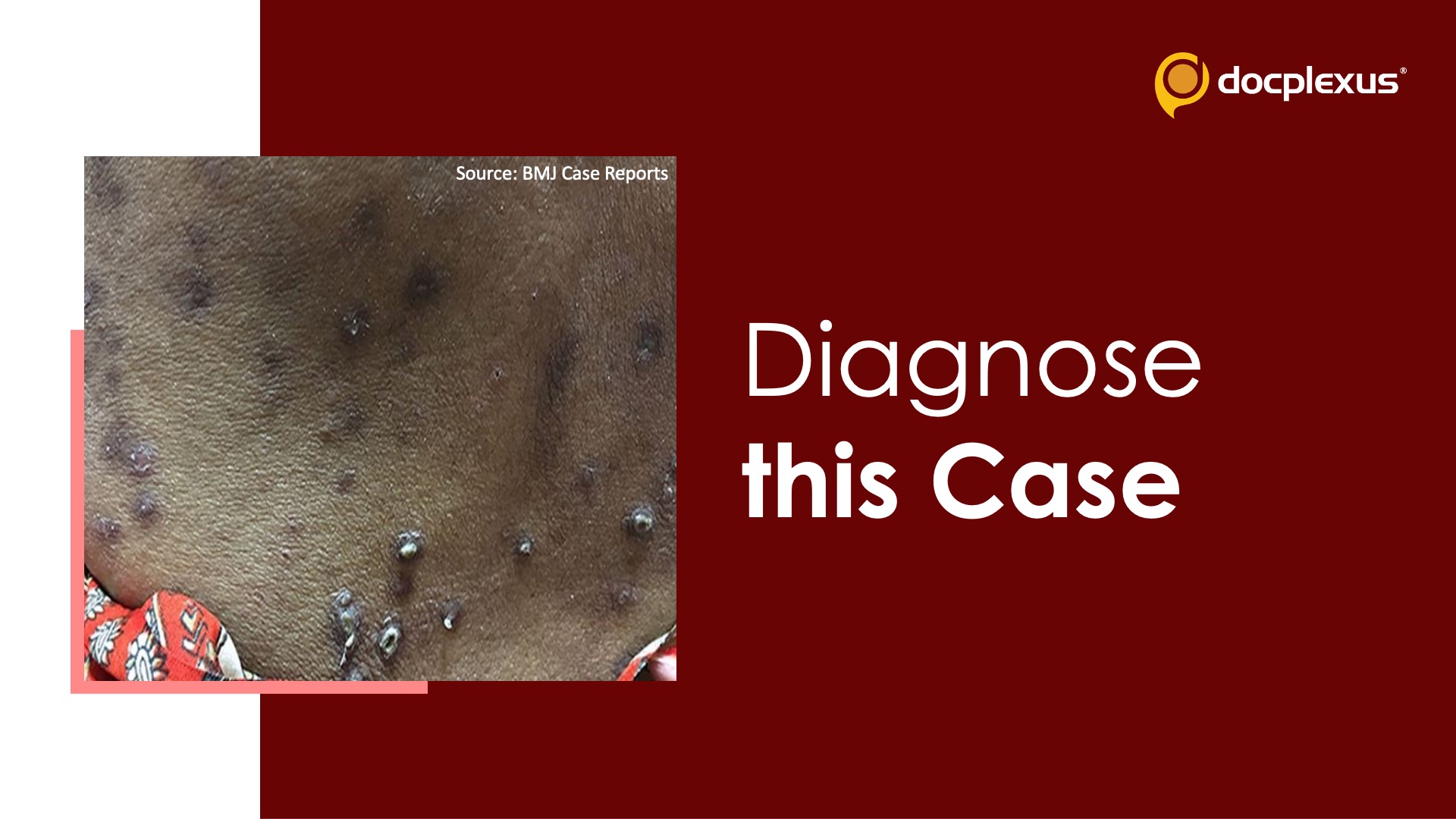 Can You Diagnose This Case of Multiple Itchy Skin Lesions?
