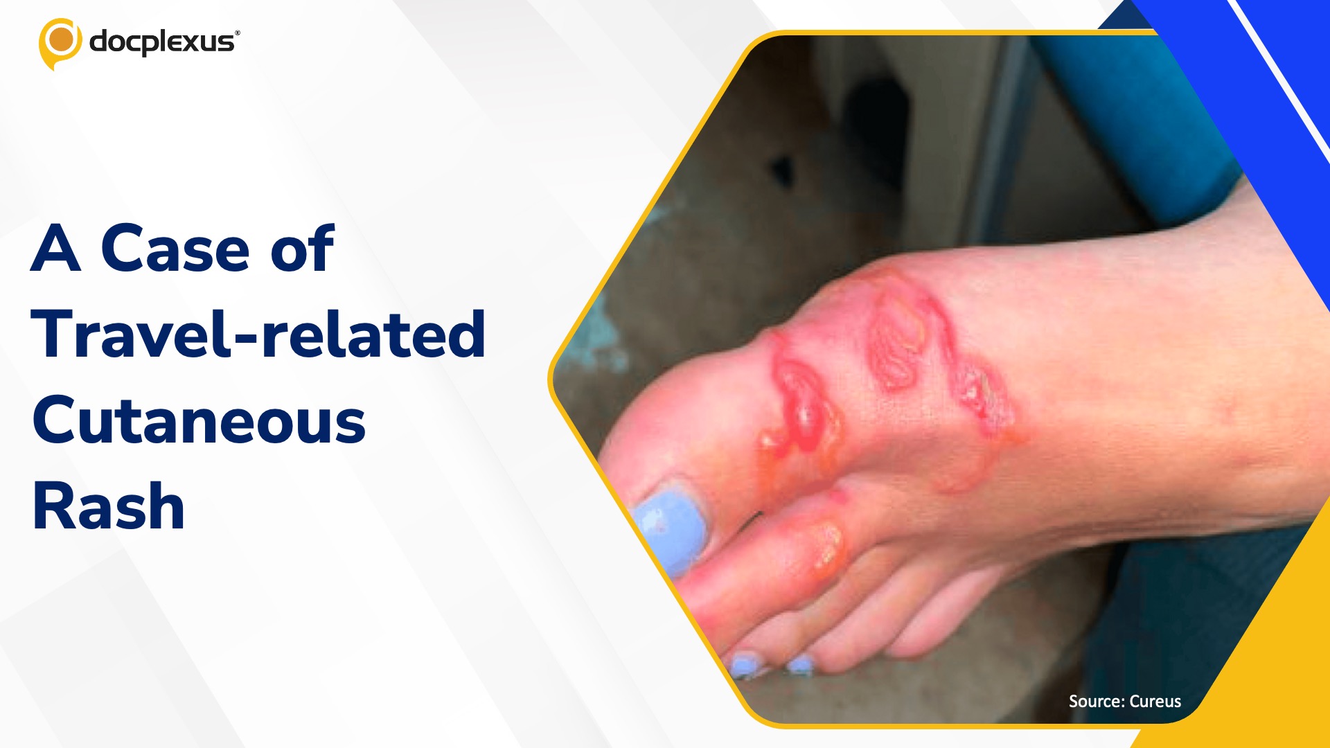 Can You Diagnose This Travel-related Serpiginous Rash?