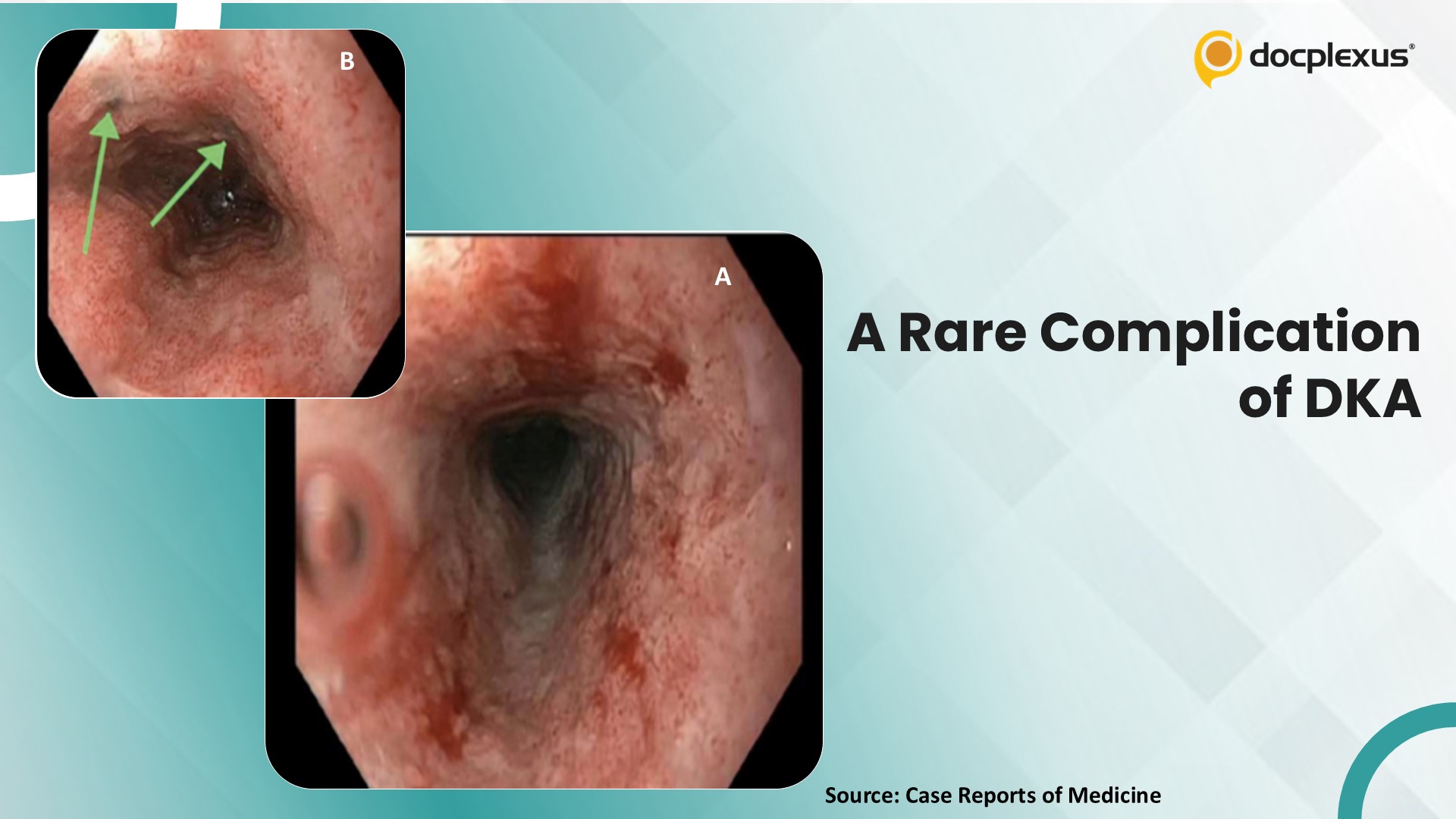 Diagnose This Rare Complication of Diabetic Ketoacidosis