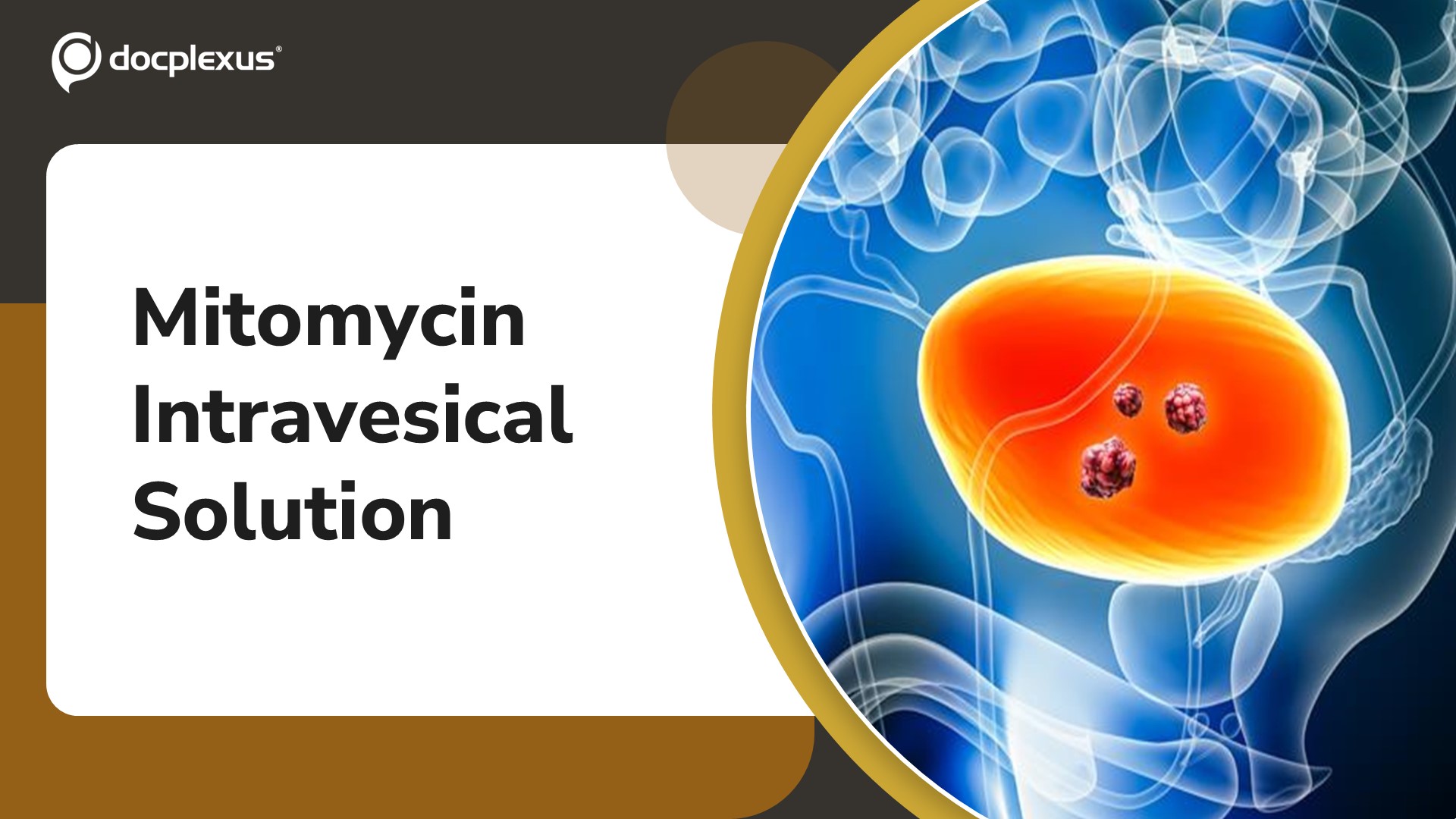 USFDA Approves Mitomycin Intravesical Solution for Bladder Cancer