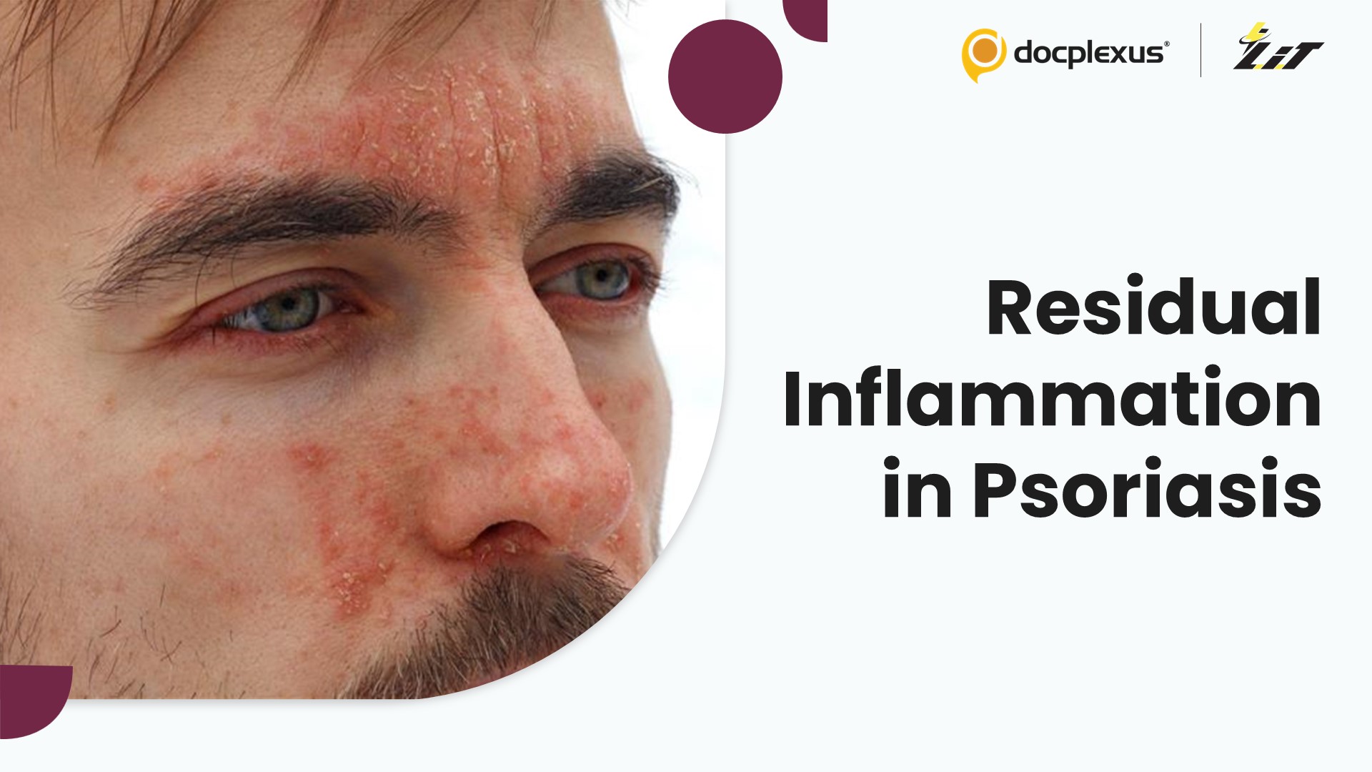 Residual Inflammation in Psoriasis Linked to Broader Health Risks