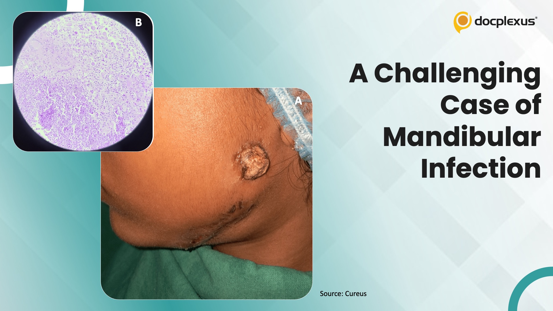 Persistent Mandibular Infection in an Adolescent: Diagnostic Dilemma in Disguise