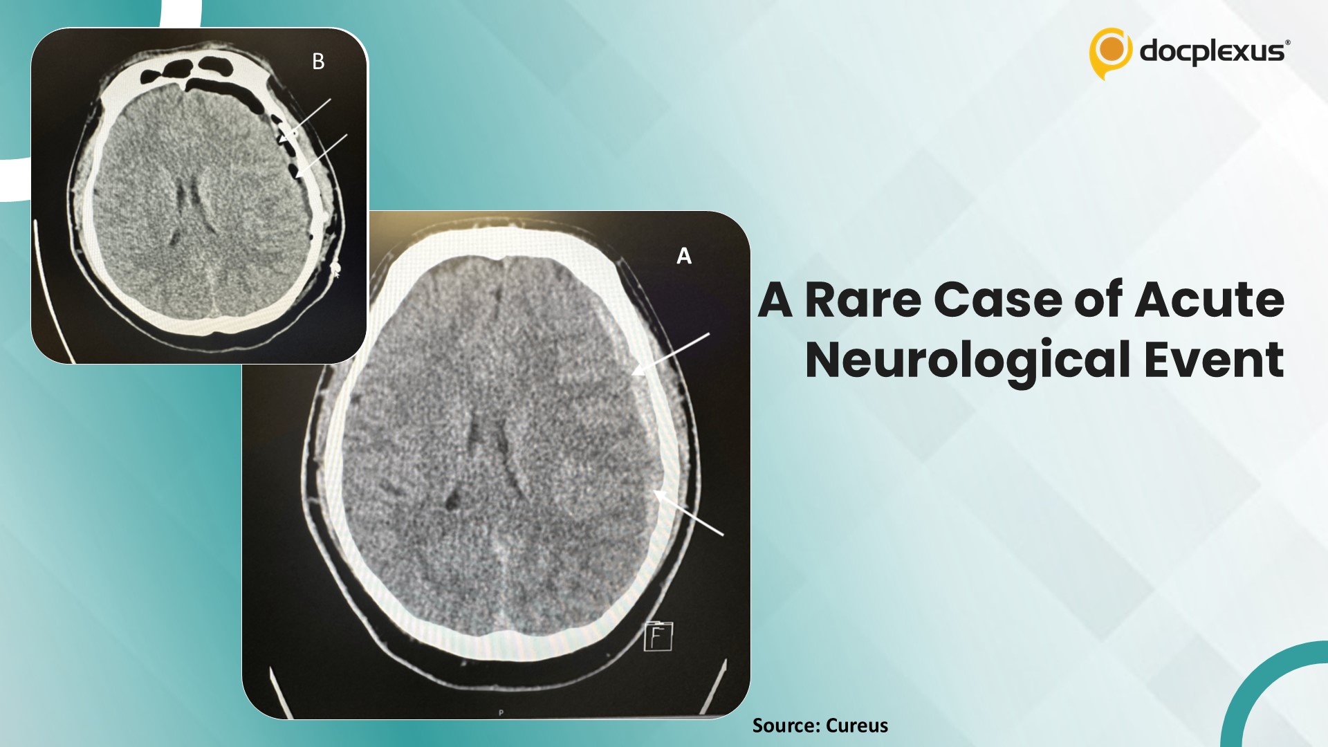 Can You Diagnose This Rare Neurological Event Triggered by Exercise?