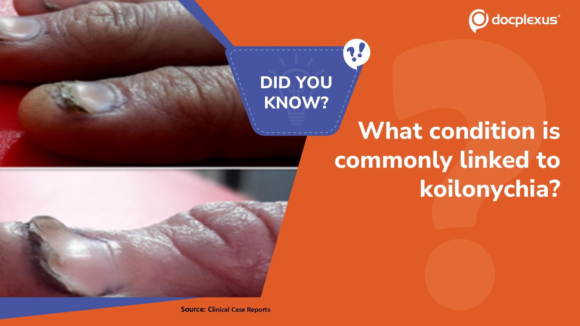 Name the Condition Most Commonly Associated with Koilonychia
