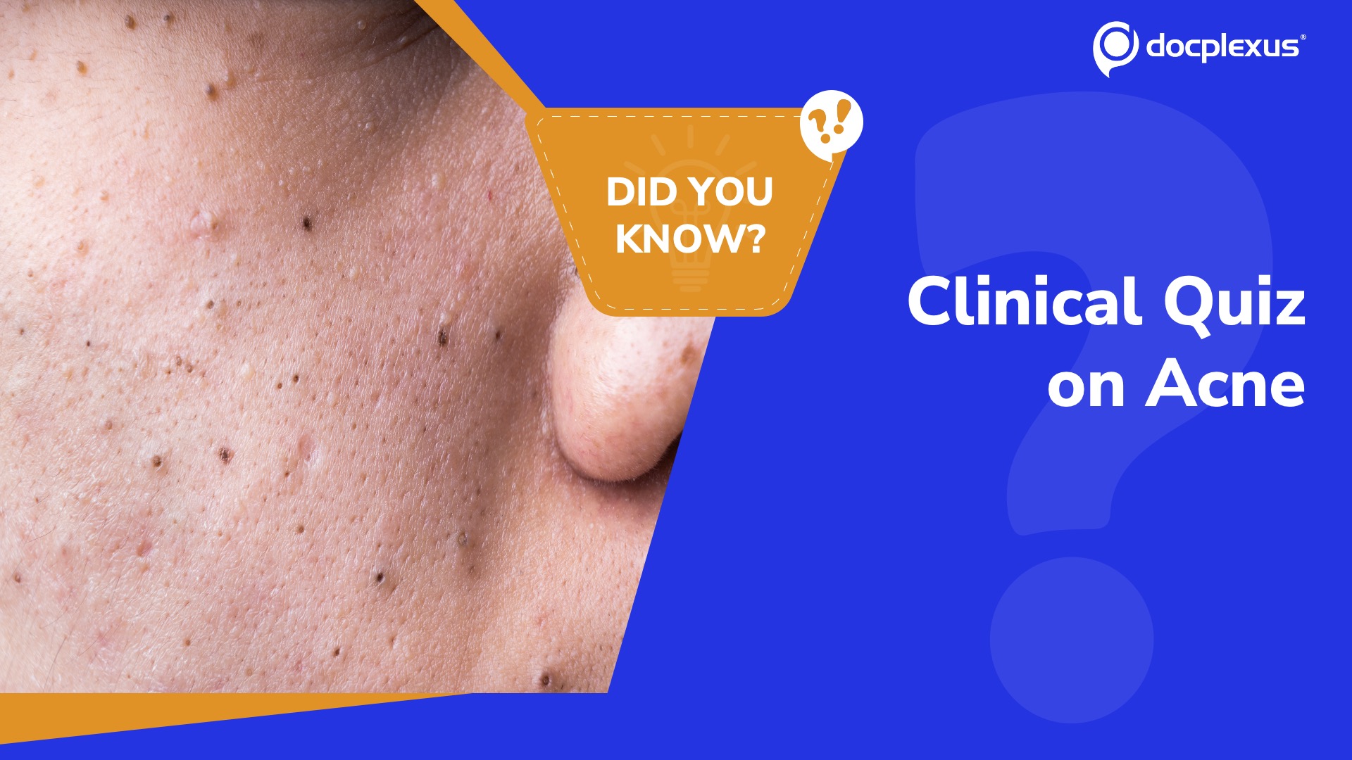 Quick Quiz: Therapeutic Approach to Comedonal Acne