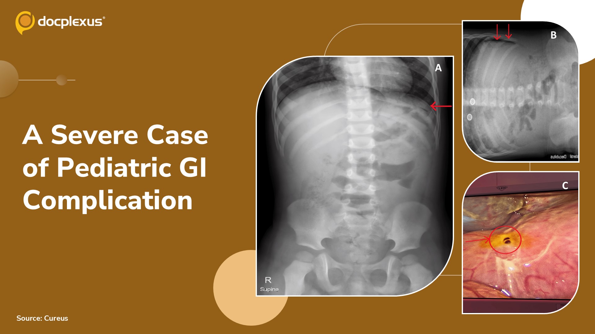 Can you Diagnose This Rare Gastrointestinal Complication in a Child?