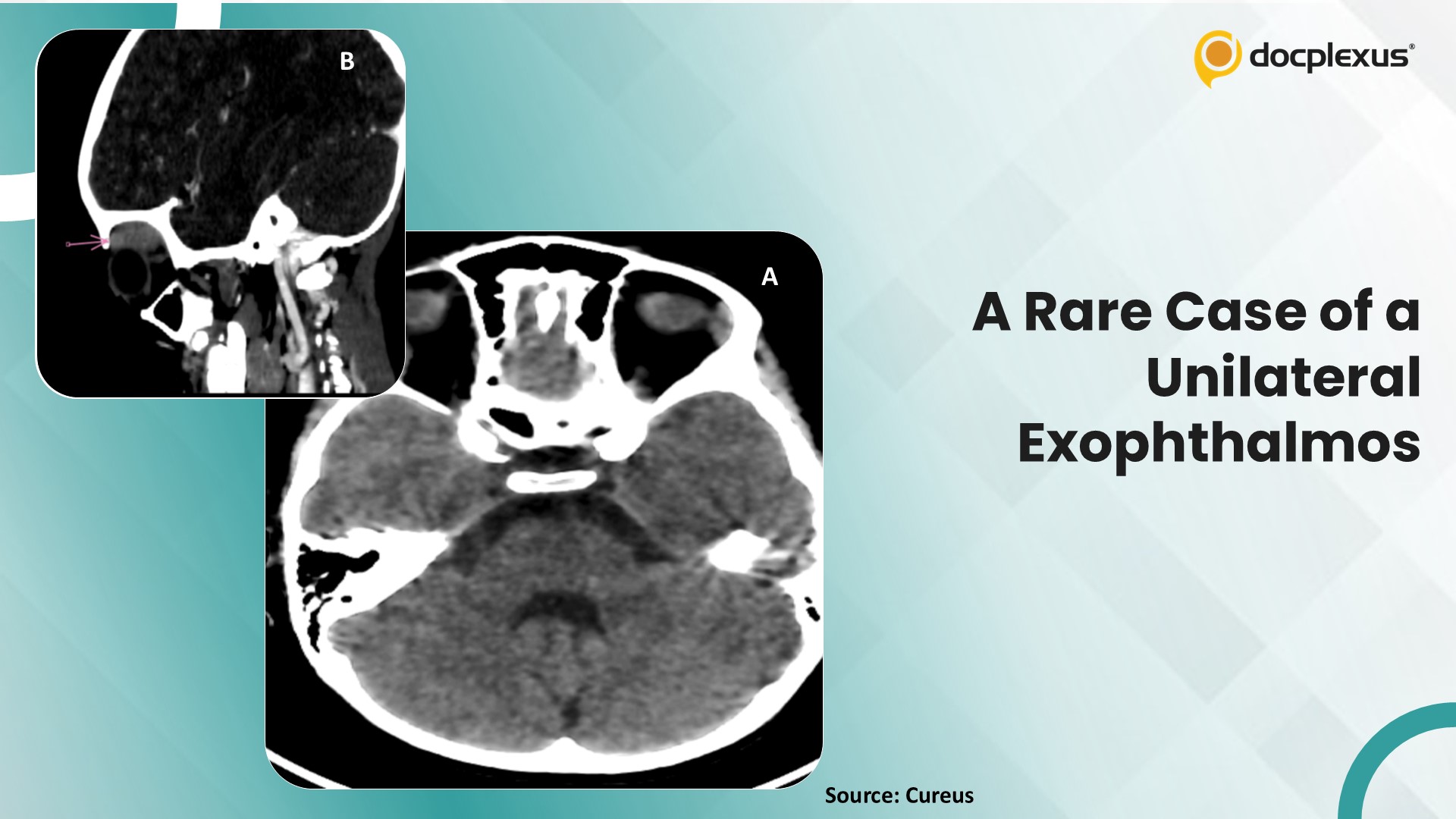 Diagnose This Rare Case of Unilateral Exophthalmos