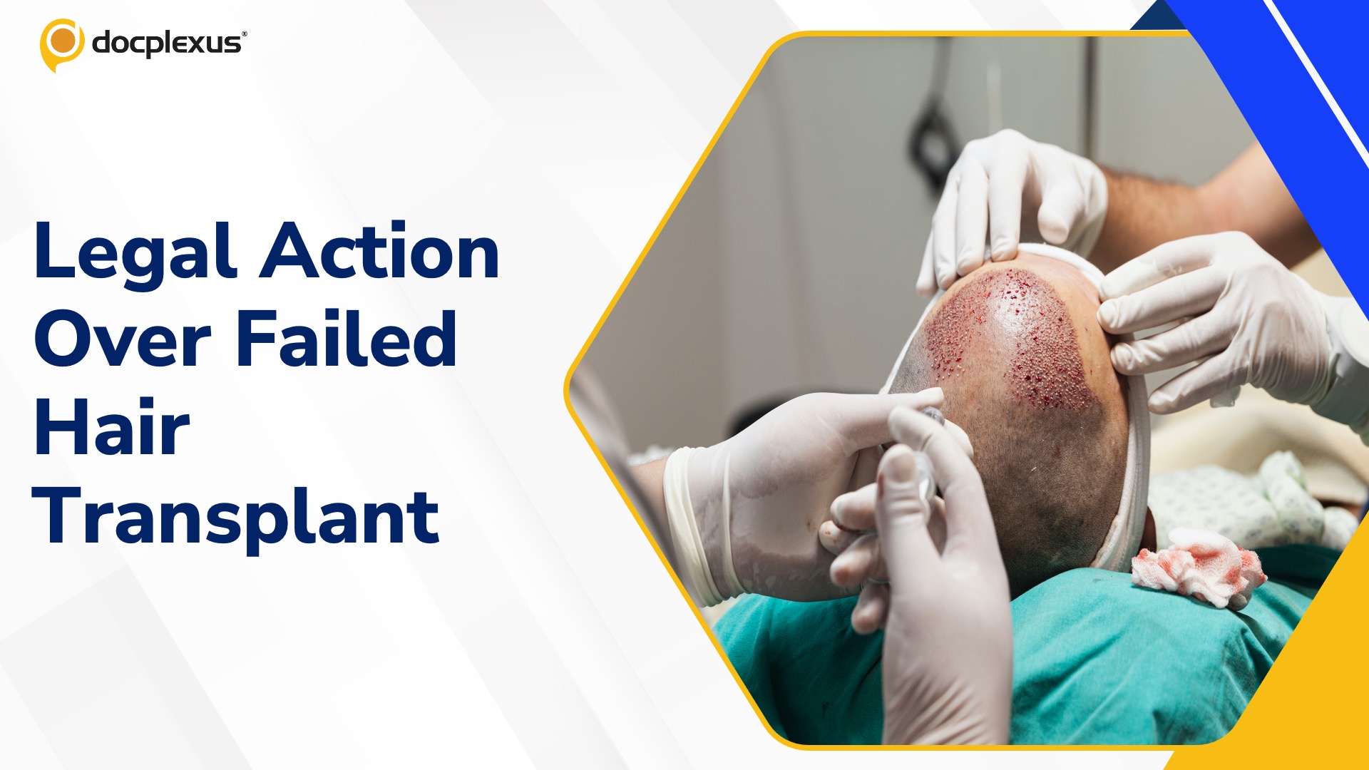 Unlicensed Hair Transplant Lands Delhi Clinic in Legal Trouble