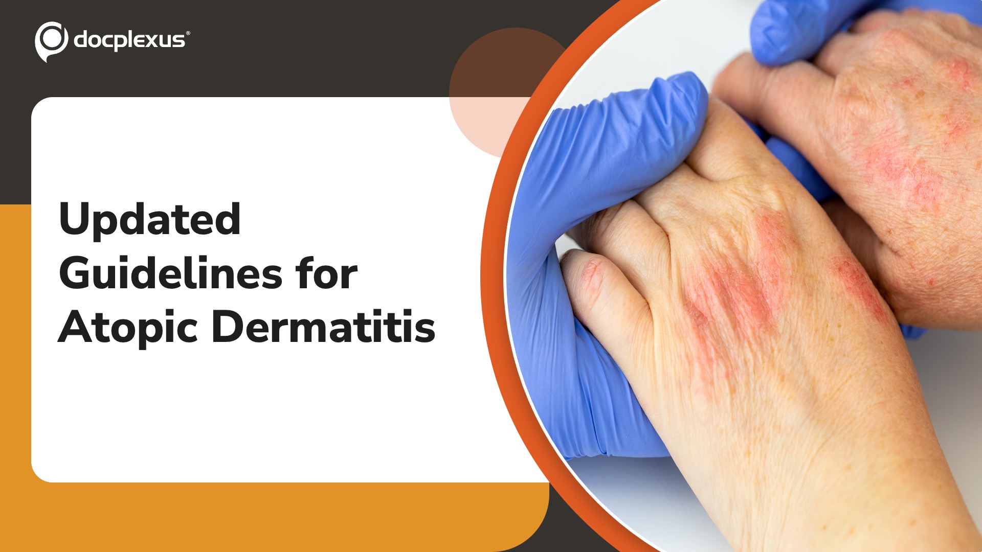 Atopic Dermatitis: AAD Guidelines 2025