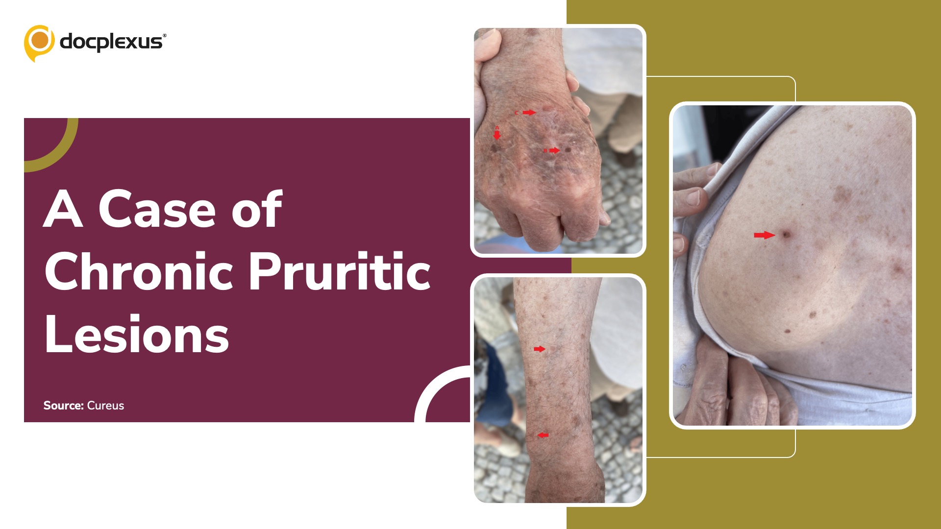 Chronic Pruritic Lesions in an Elderly Patient: What’s Your Diagnosis?