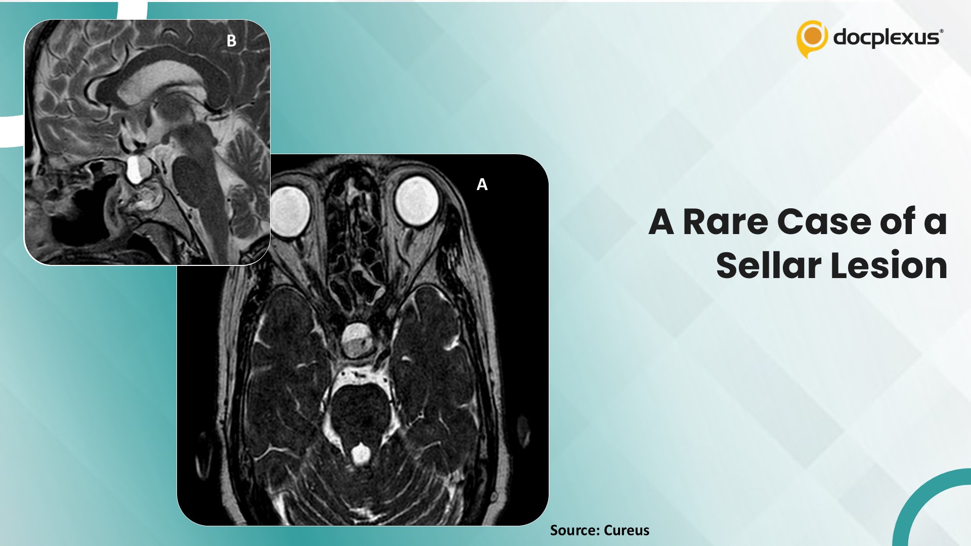 Diagnose This Rare Case of an Unusual Sellar Mass