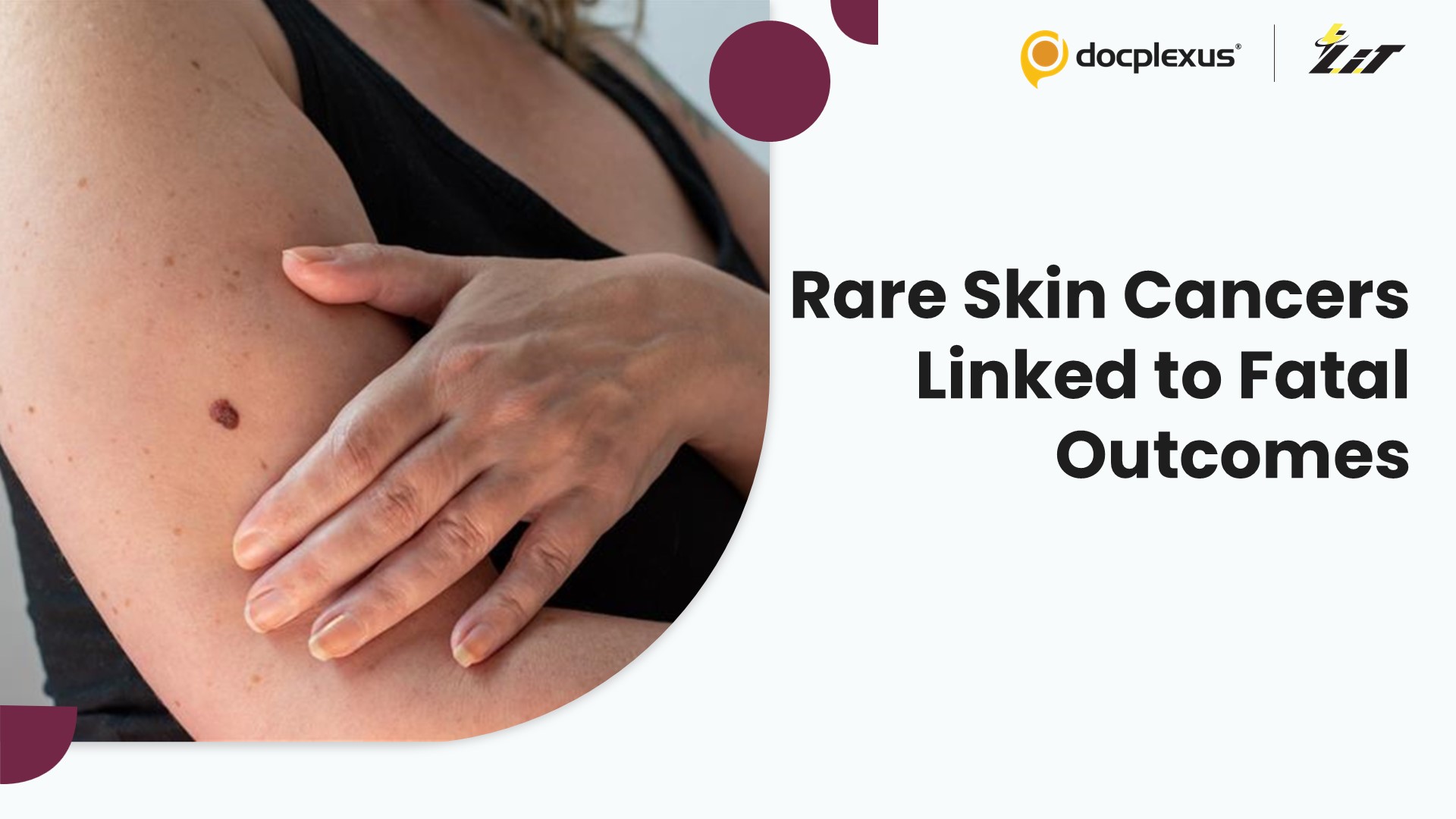 Rare Skin Cancers Carry Increased Risk of Fatal Lymphoma and Infections