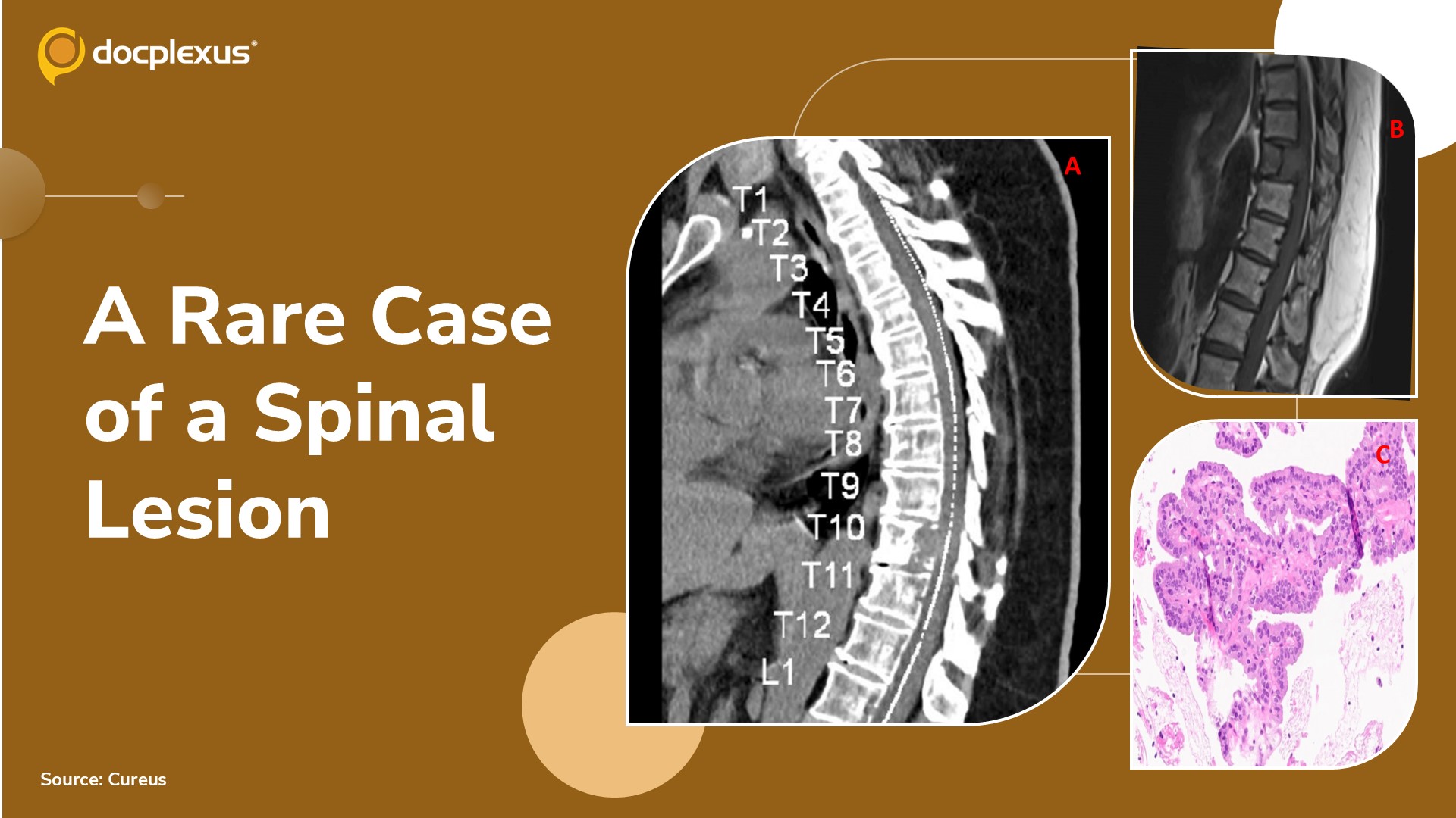 Diagnose This Rare Case of a Mysterious Spinal Lesion