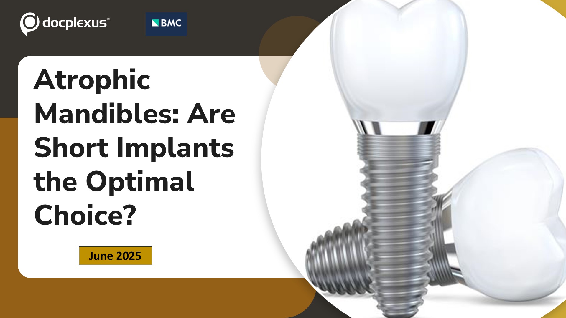 Atrophic Mandibles: Are Short Implants the Optimal Choice?