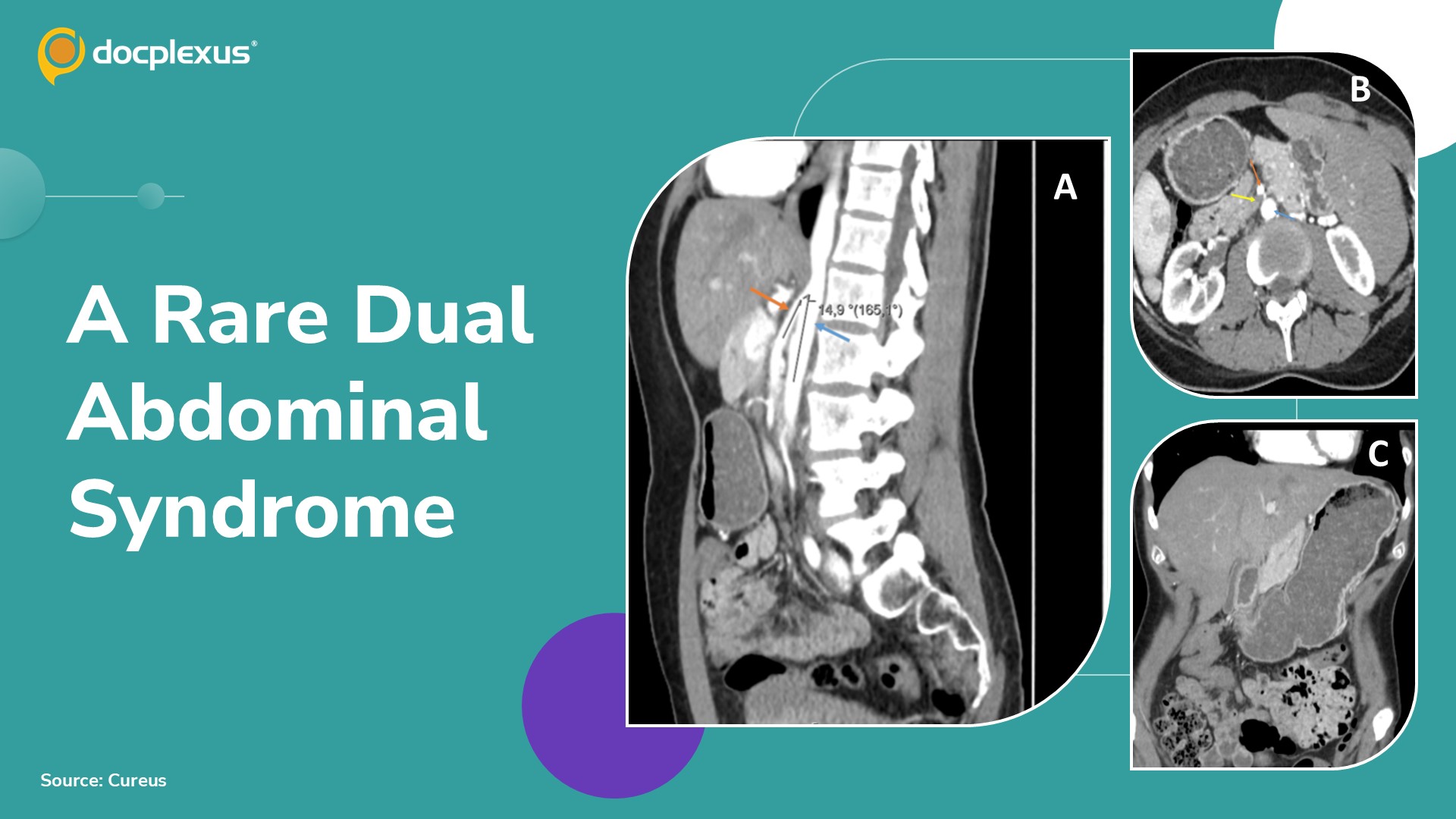 Diagnose This Rare Dual Abdominal Syndrome