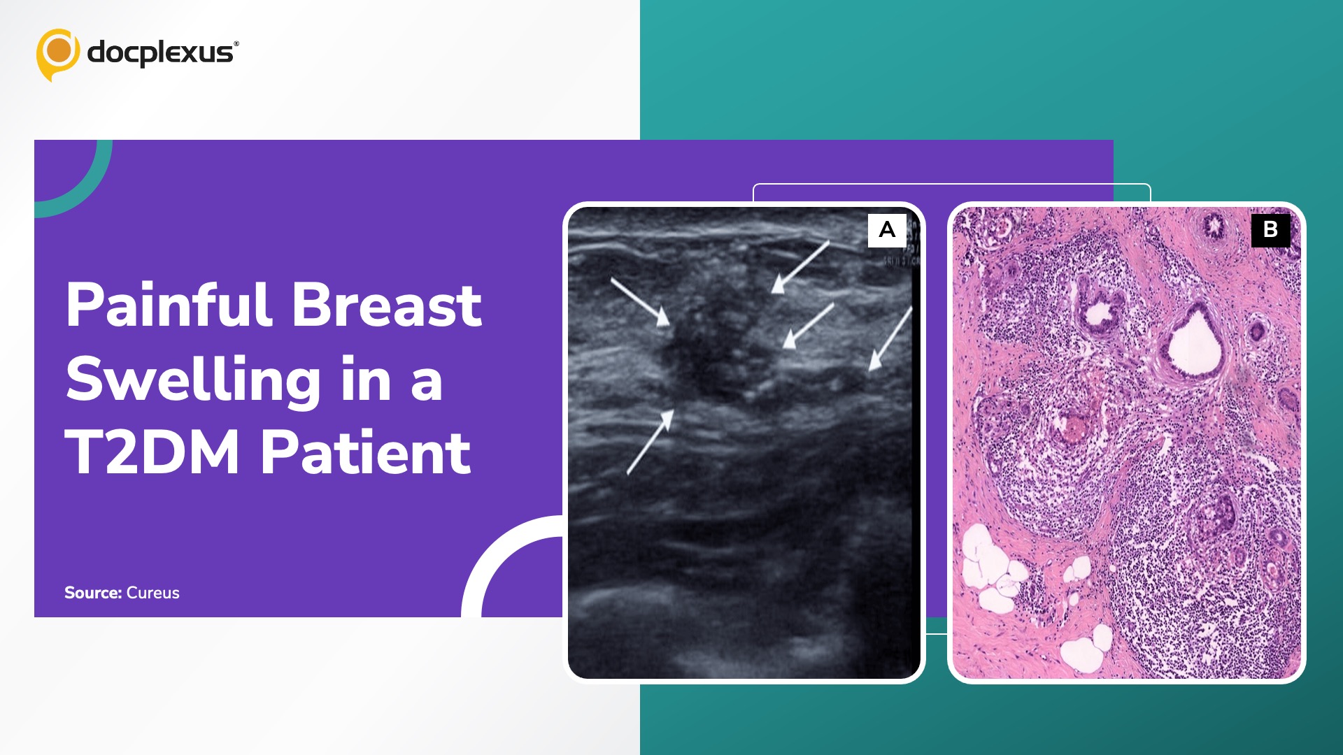 Solve This Challenging Breast Lump Case in a Diabetic Patient