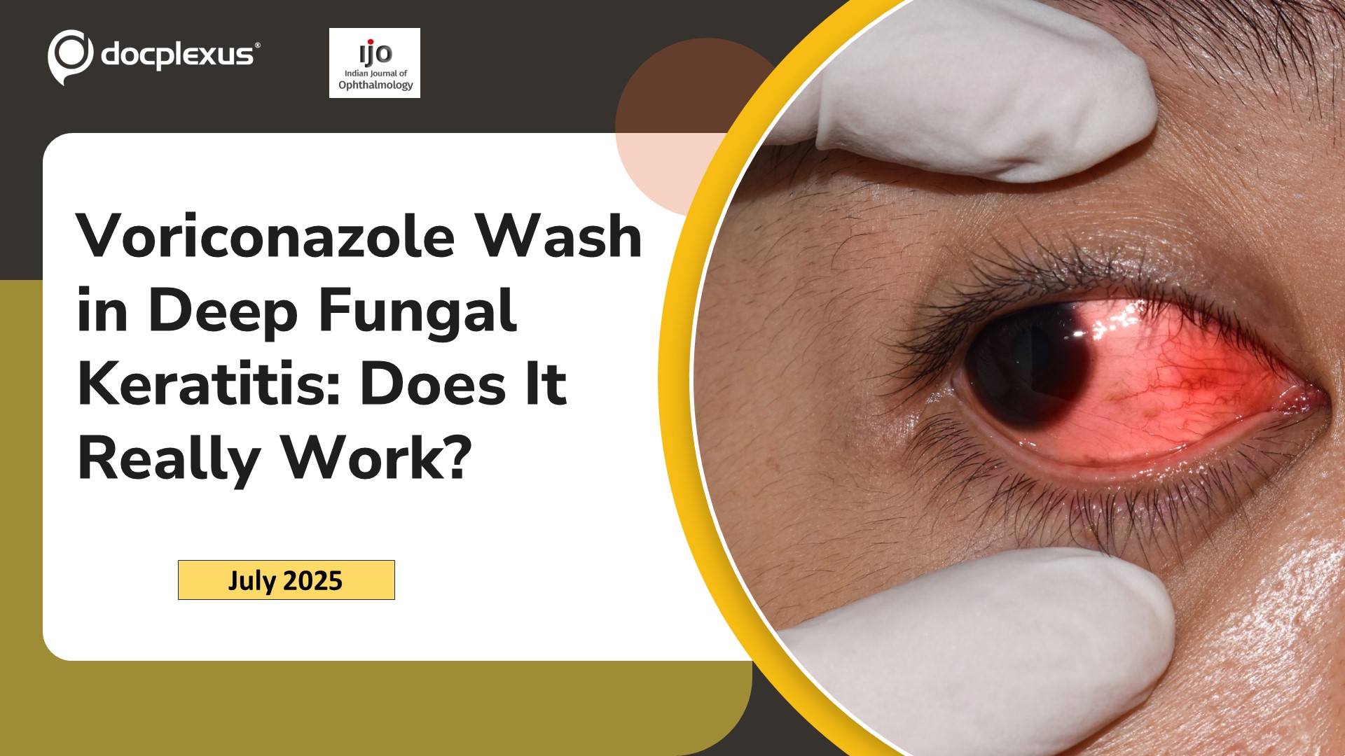 Voriconazole Wash in Deep Fungal Keratitis: Does It Really Work?