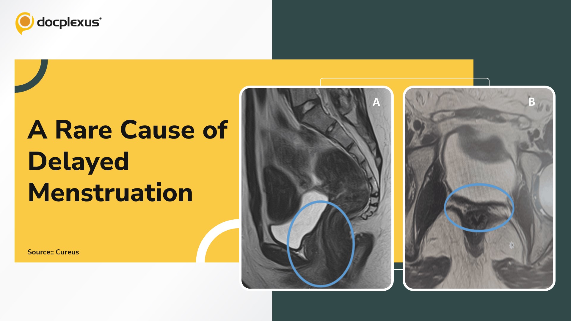Diagnose This Rare Cause of Delayed Menstruation