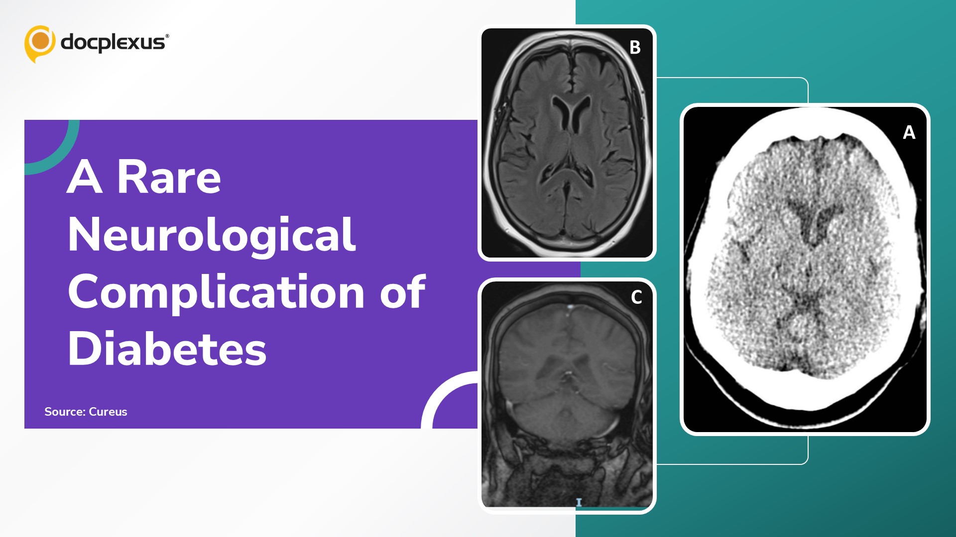 Can You Identify This Rare Diabetes-Associated Neurological Case?