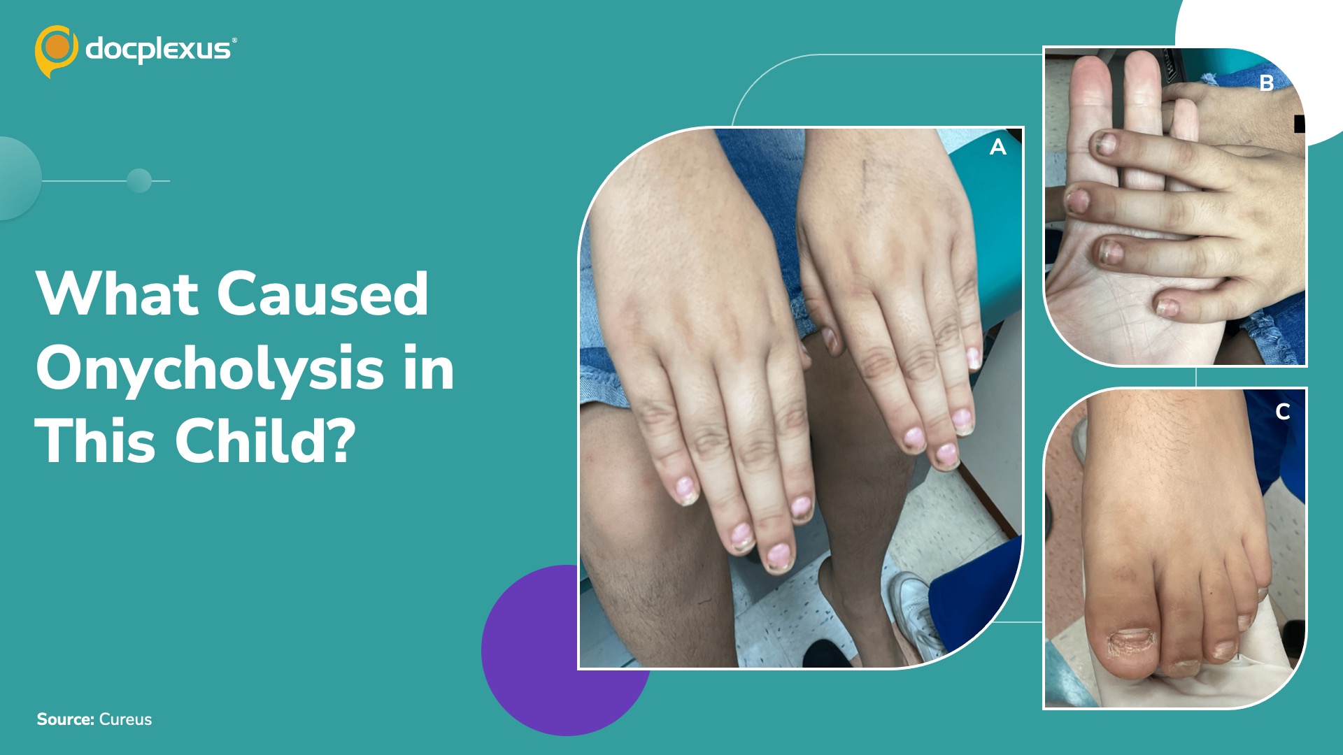 A Puzzling Nail Transformation in an 11-Year-Old: What’s Your Diagnosis?