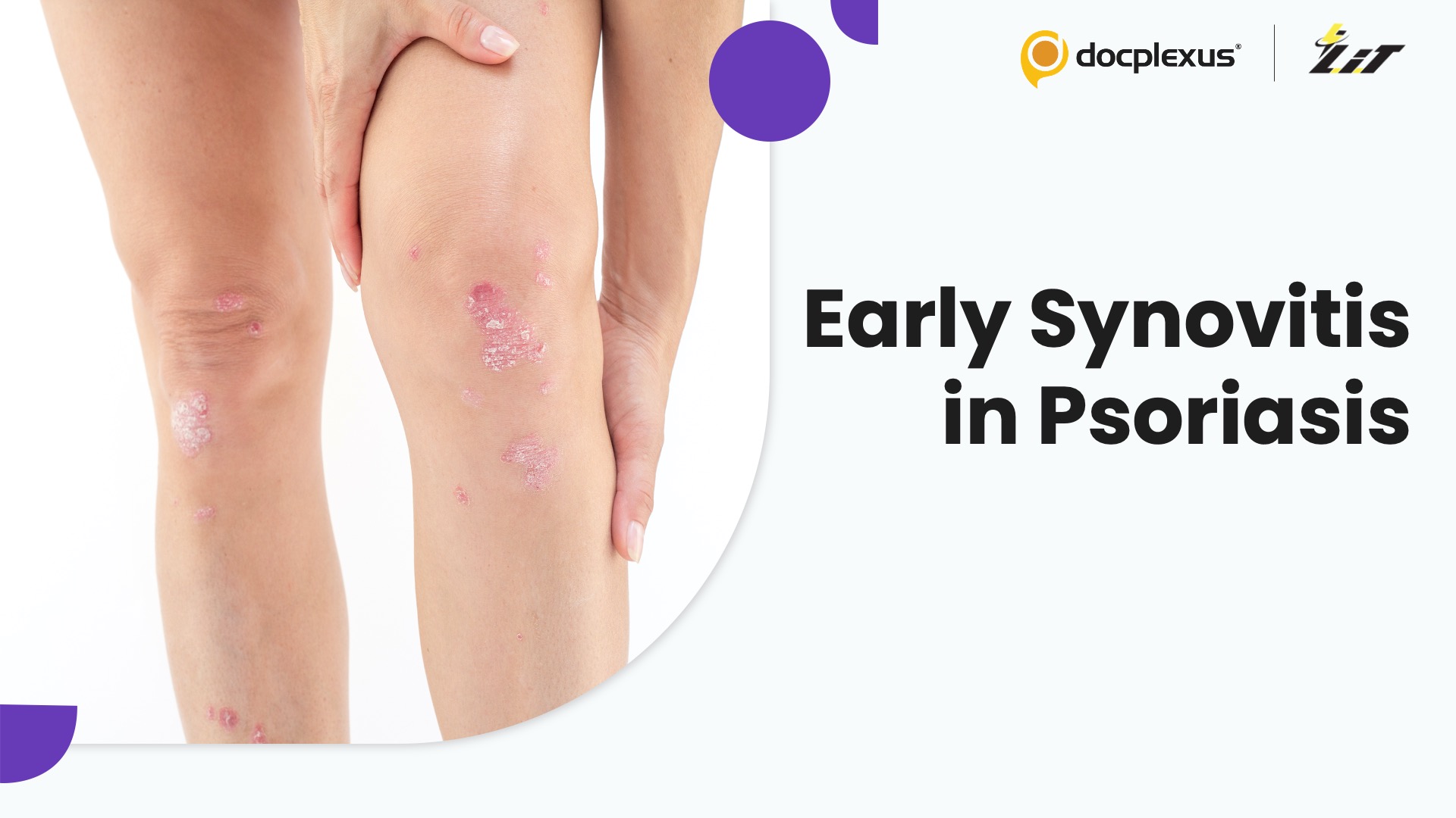 Synovitis in Psoriasis: Detecting Early Warning Signs