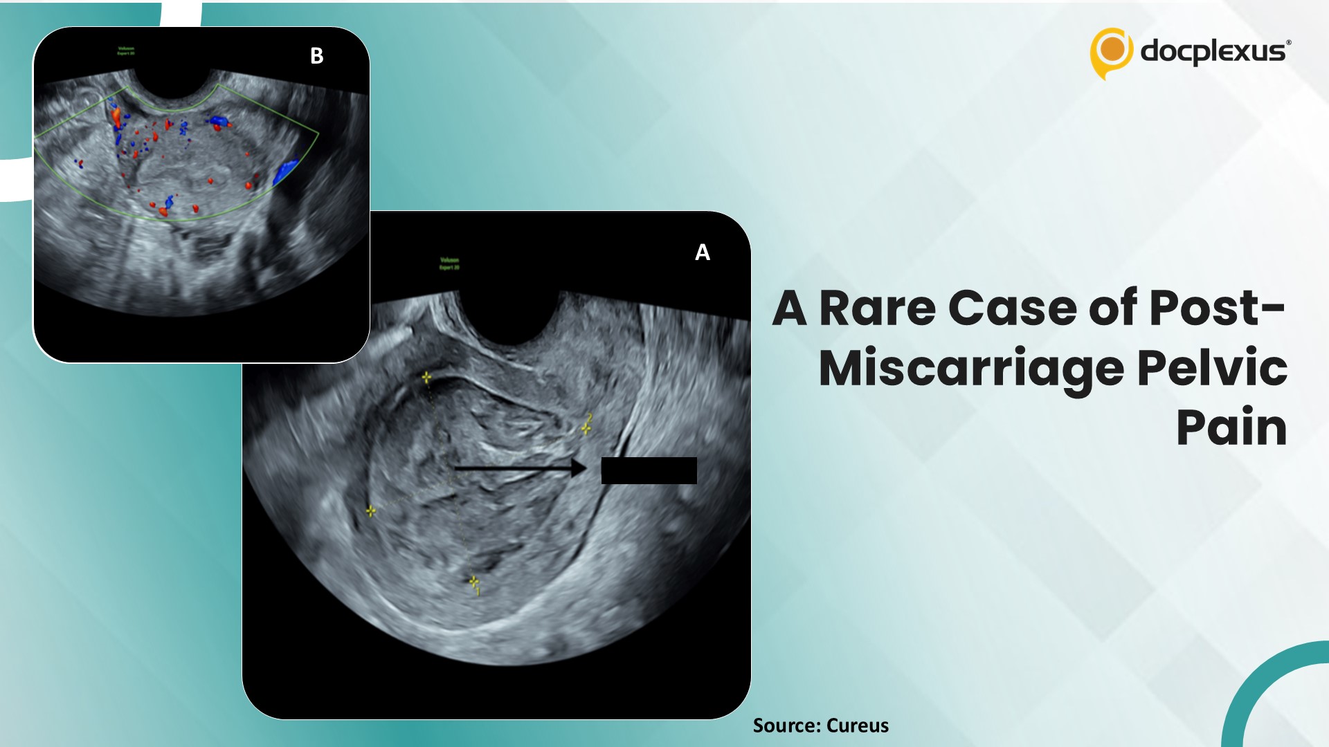 Diagnose This Rare Case of Sudden-Onset Pelvic Pain After Miscarriage