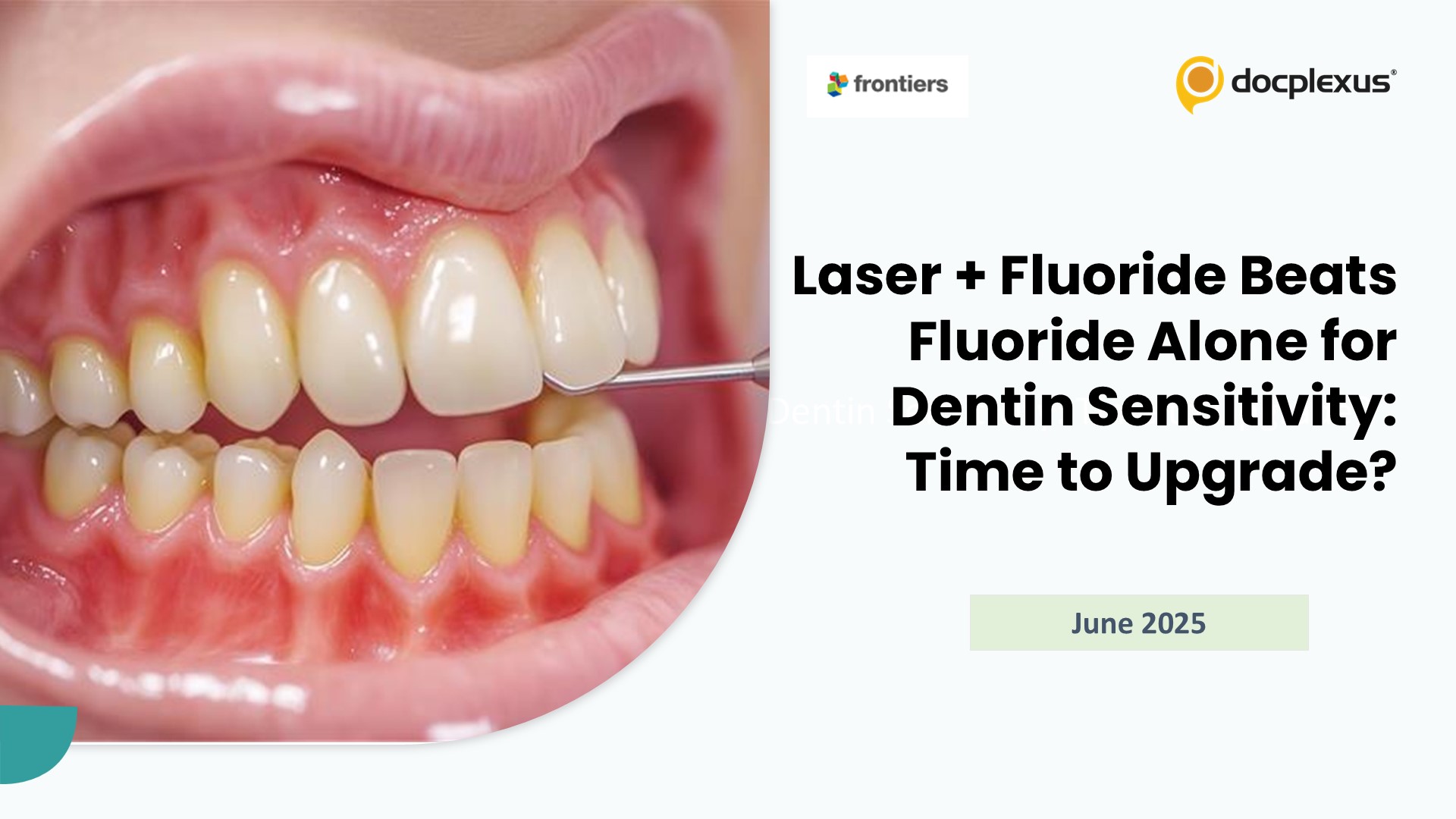 Laser + Fluoride Beats Fluoride Alone for Dentin Sensitivity: Time to Upgrade?