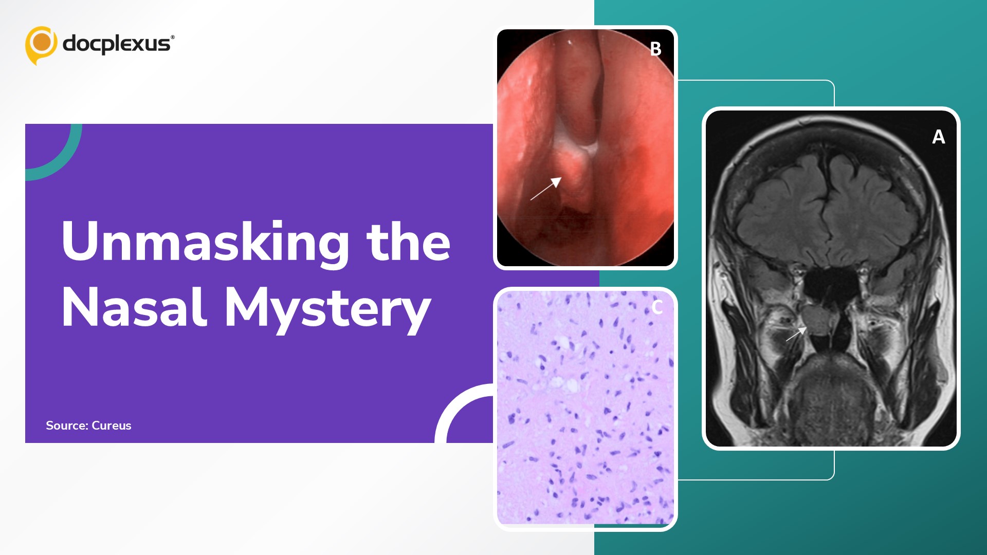 Diagnose an Asymptomatic Nasal Mass in an Elderly Patient
