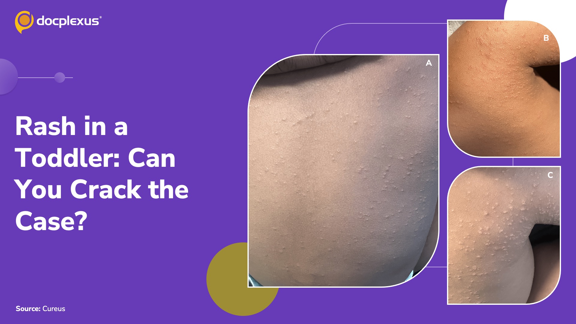 From Back to Face: The Mystery Rash in a Toddler