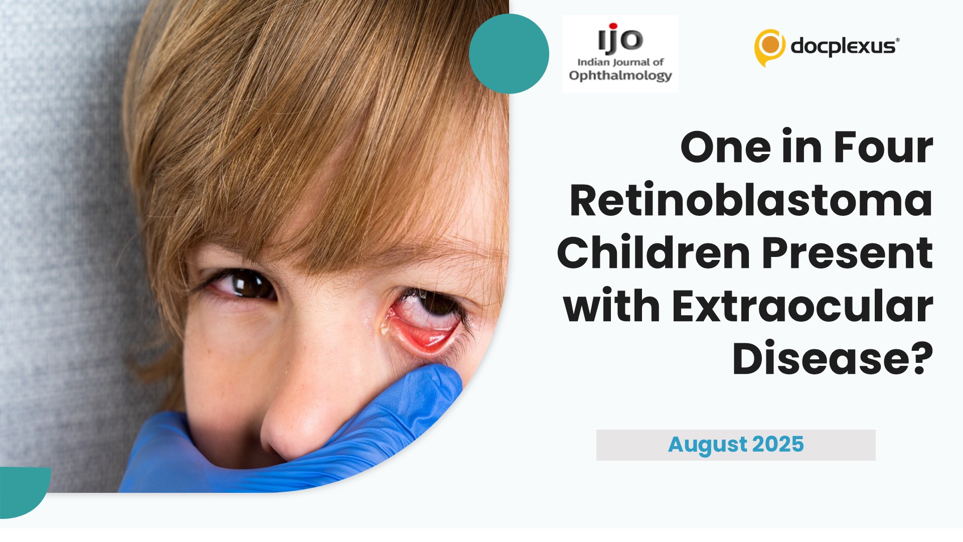One in Four Retinoblastoma Children Present with Extraocular Disease?