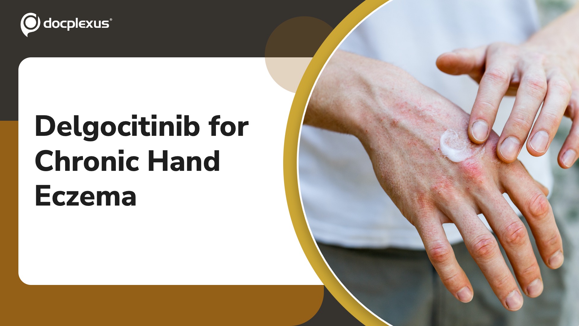 USFDA Approves Delgocitinib for Chronic Hand Eczema