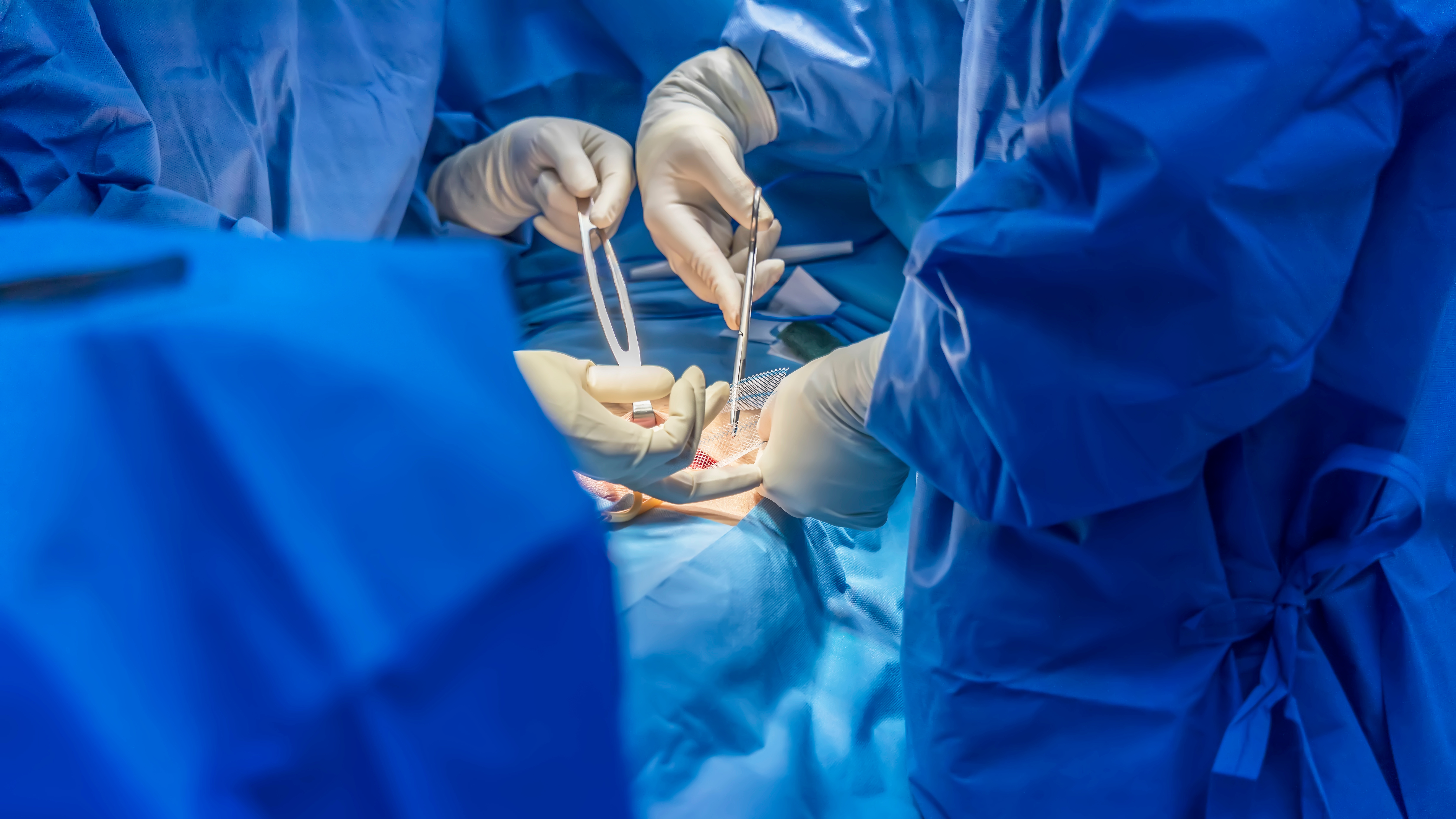 Stercoral Perforation of Colon: A Rare Case Report